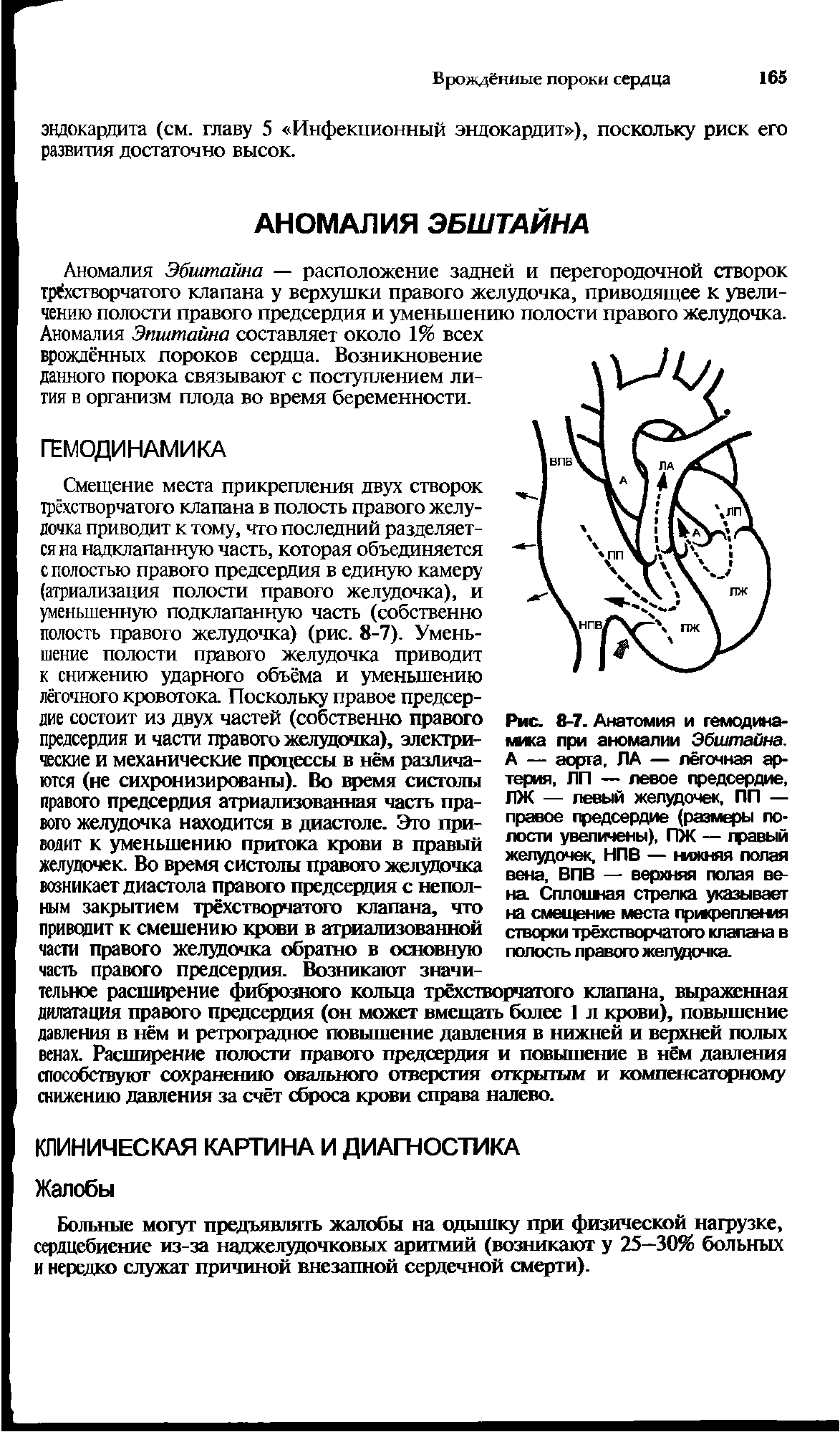 Рис. 8-7. Анатомия и гемодинамика при аномалии Эбштайна. А — аорта, ЛА — легочная артерия, ЛП — левое предсердие, ЛЖ — левый желудочек, ПП — правое предсердие (размеры полости увеличены), ПЖ — гравый желудочек, НПВ — нижняя полая вена, ВПВ — верхняя полая вена Сплошная стрелка указывает на смещение места прикрепления створки трёхстворчатого клапана в полость правого желудочка.