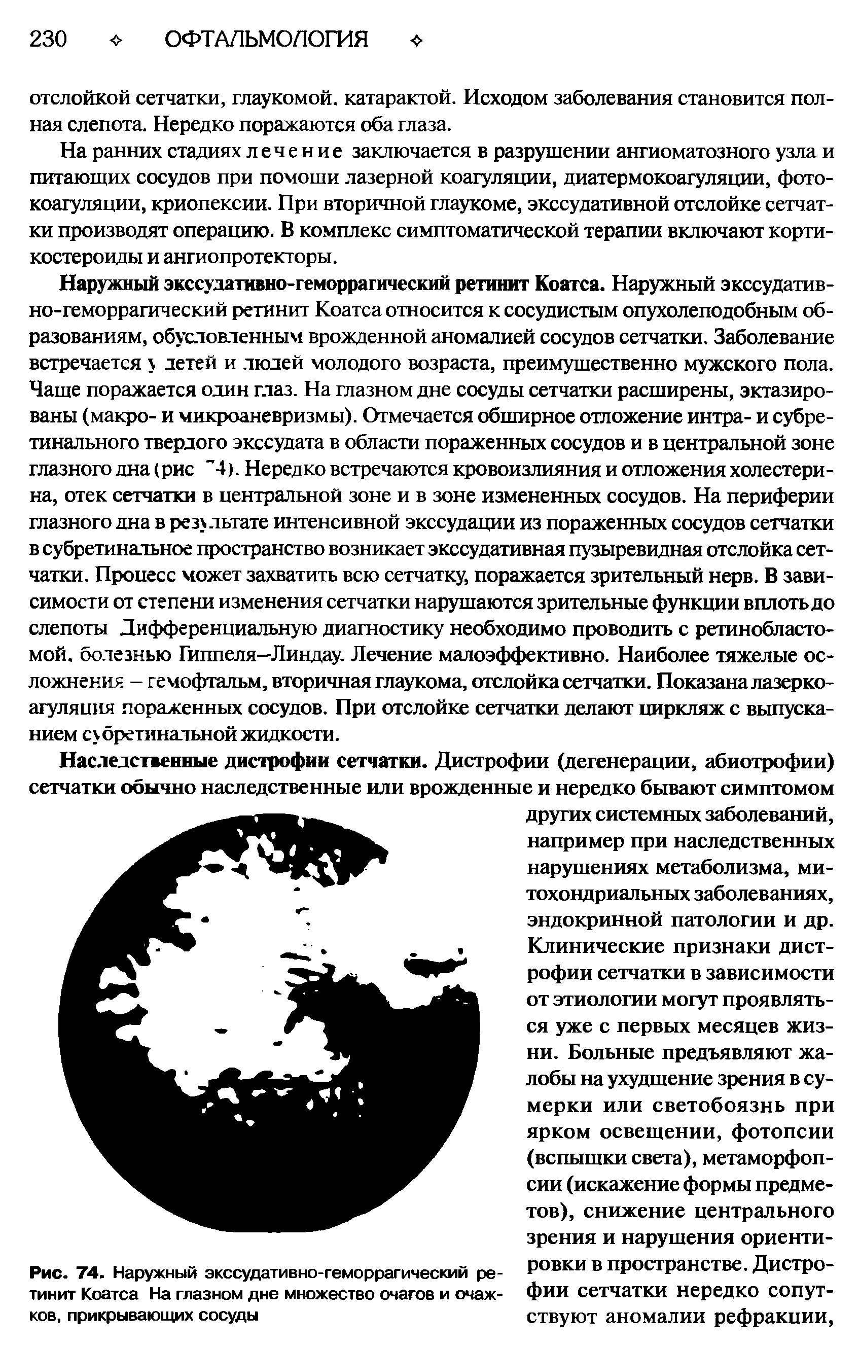 Рис. 74. Наружный экссудативно-геморрагический ретинит Коатса На глазном дне множество очагов и очажков, прикрывающих сосуды...