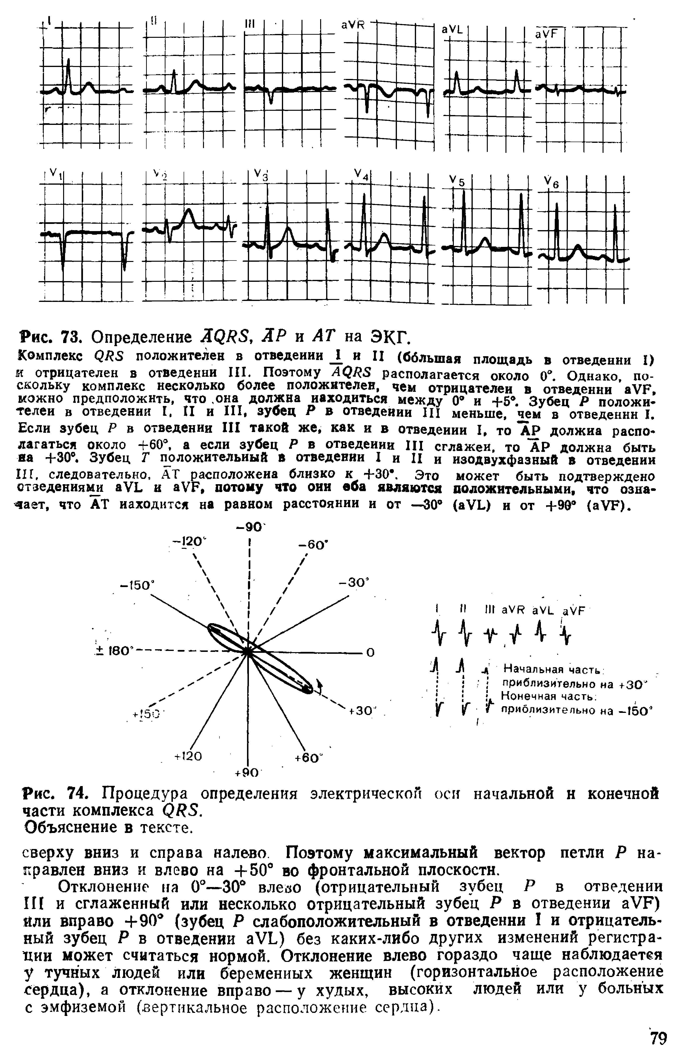 Рис. 74. Процедура определения электрической оси начальной н конечной части комплекса...