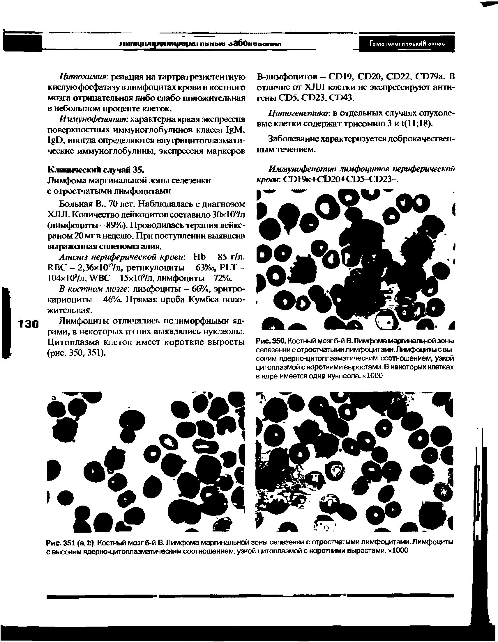Рис. 350. Костный мозг б-й В. Лимфома маргинальной зоны селезенки с отростчатыми лимфоцитами. Лимфоциты с высоким ядерно-цитоплазматическим соотношением, узкой цитоплазмой с короткими выростами. В некоторых клетках в ядре имеется одна нуклеола. хЮОО...