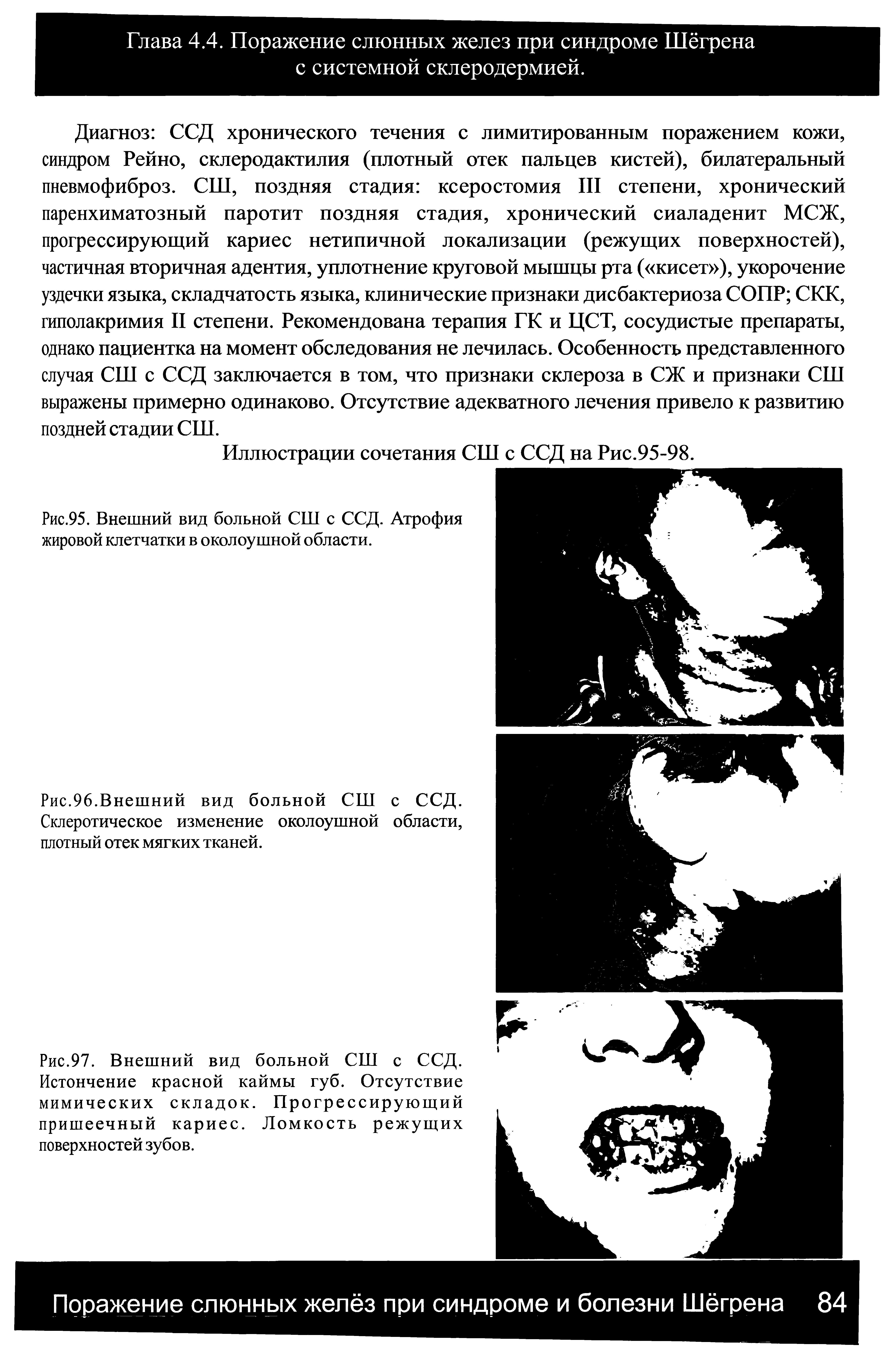 Рис.95. Внешний вид больной СШ с ССД. Атрофия жировой клетчатки в околоушной области.