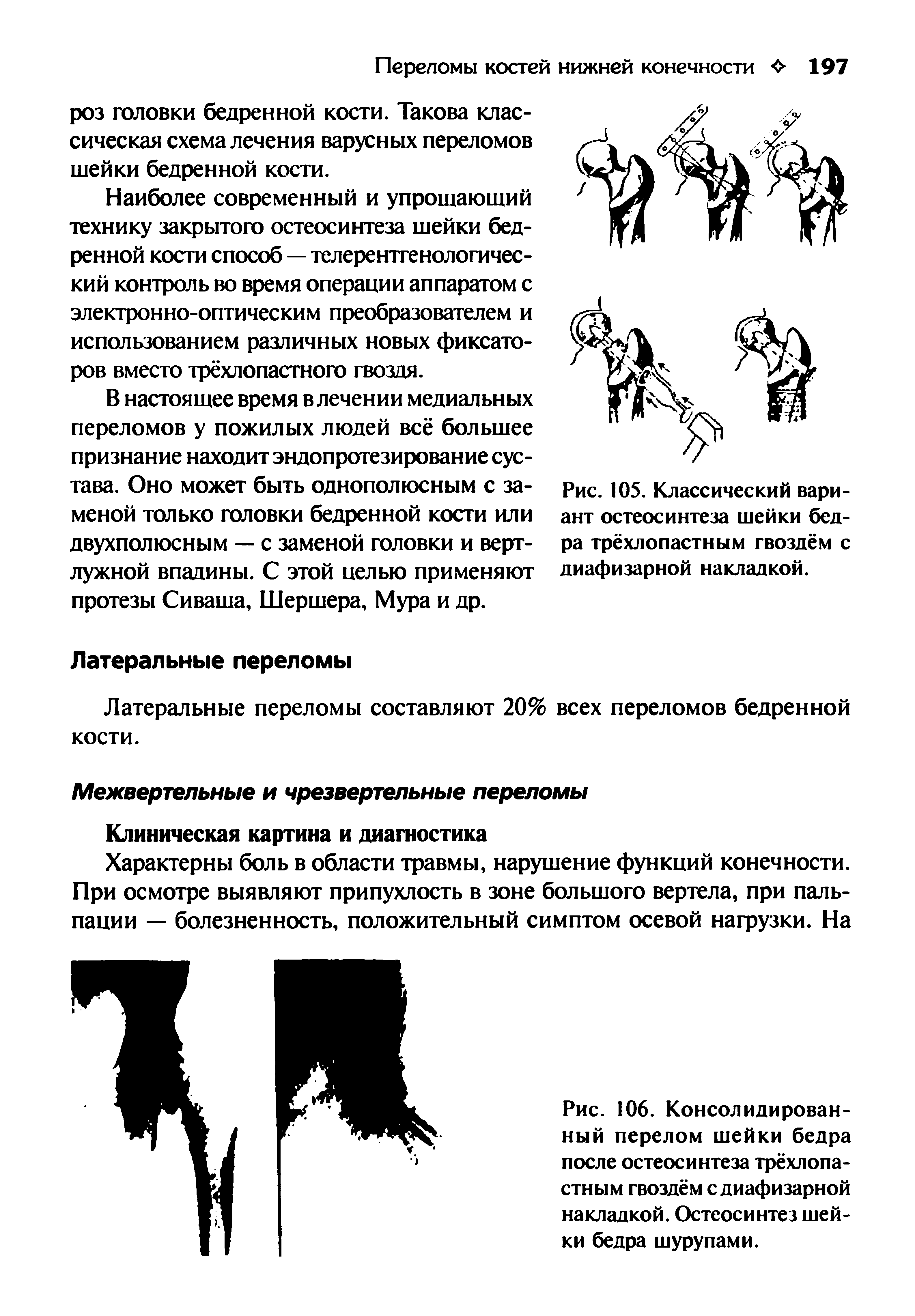 Рис. 106. Консолидированный перелом шейки бедра после остеосинтеза трёхлопастным гвоздём с диафизарной накладкой. Остеосинтез шейки бедра шурупами.