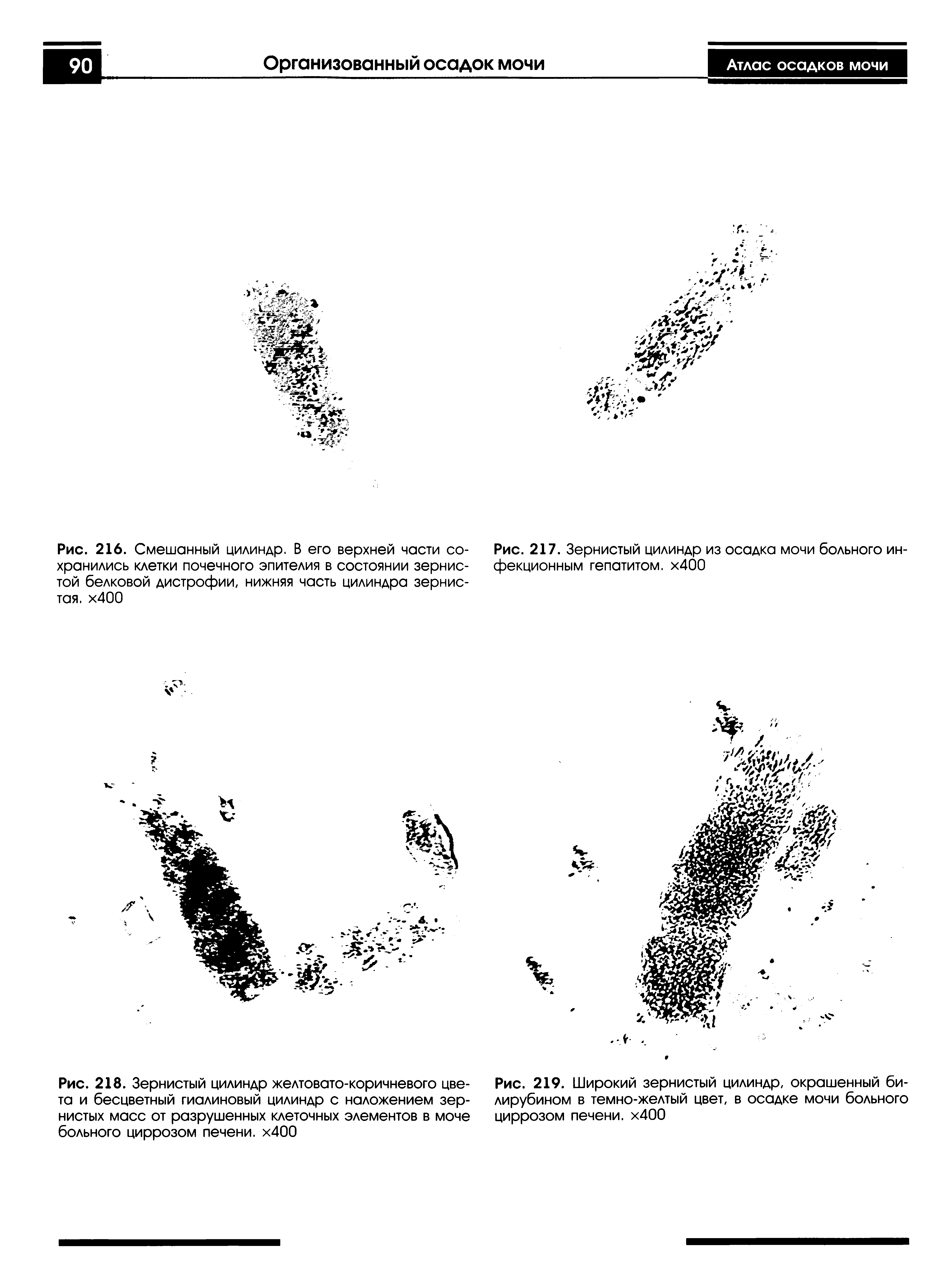 Рис. 216. Смешанный цилиндр. В его верхней части сохранились клетки почечного эпителия в состоянии зернистой белковой дистрофии, нижняя часть цилиндра зернистая. х400...