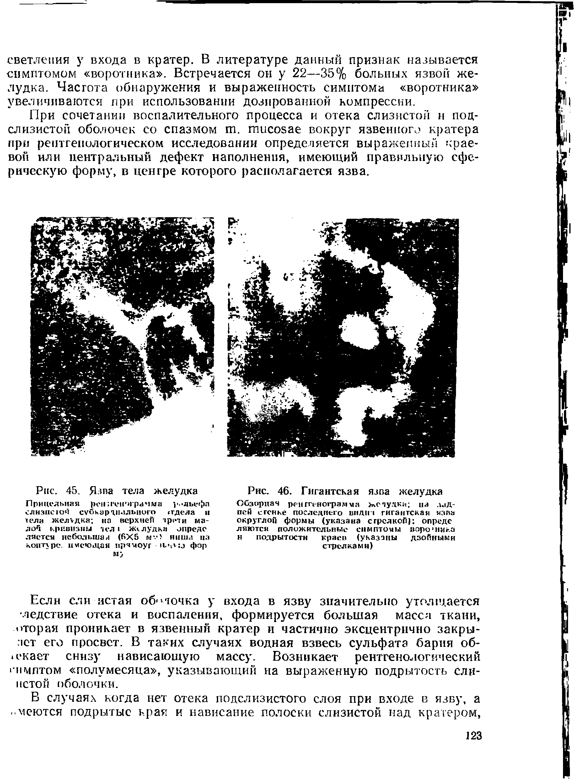 Рис. 45. Язва тела желудка Прицельная реп и ен ирачма рельефа слизне юч субкар шального гдела и тела желудка на верхней трети малой кривизны тел I желудка опрело лястся небольшая (6X5 м. > ниша на копту ре. имеющая нрчмоуг фор...