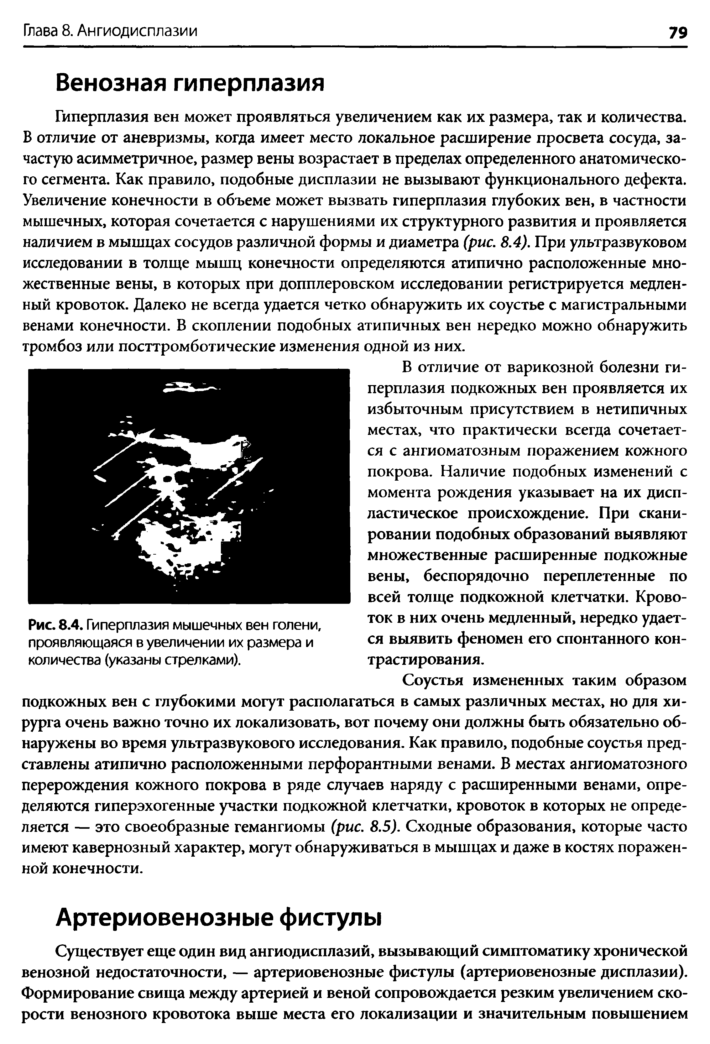 Рис. 8.4. Гиперплазия мышечных вен голени, проявляющаяся в увеличении их размера и количества (указаны стрелками).