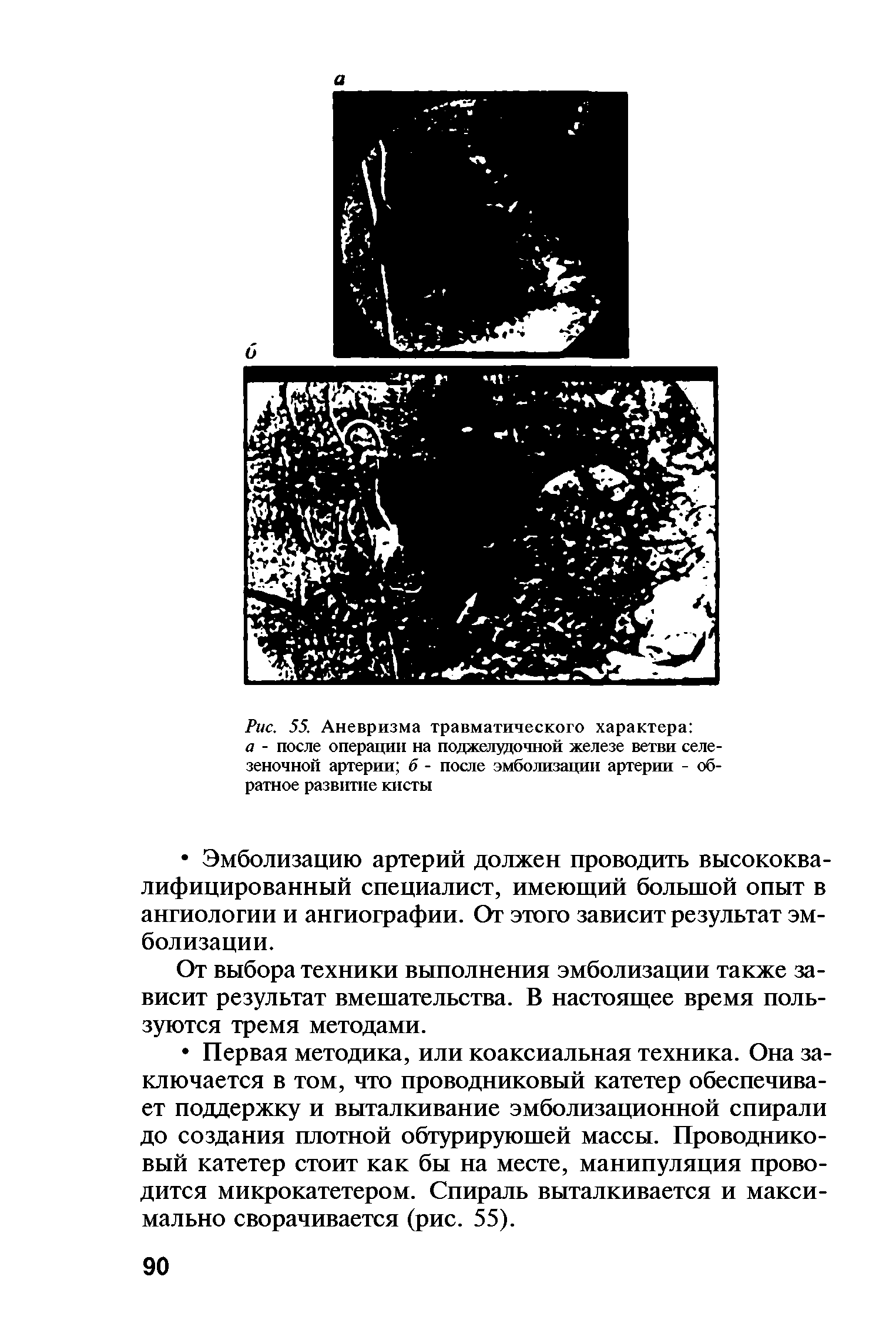 Рис. 55. Аневризма травматического характера а - после операции на поджелудочной железе ветви селезеночной артерии б - после эмболизации артерии - обратное развитие кисты...