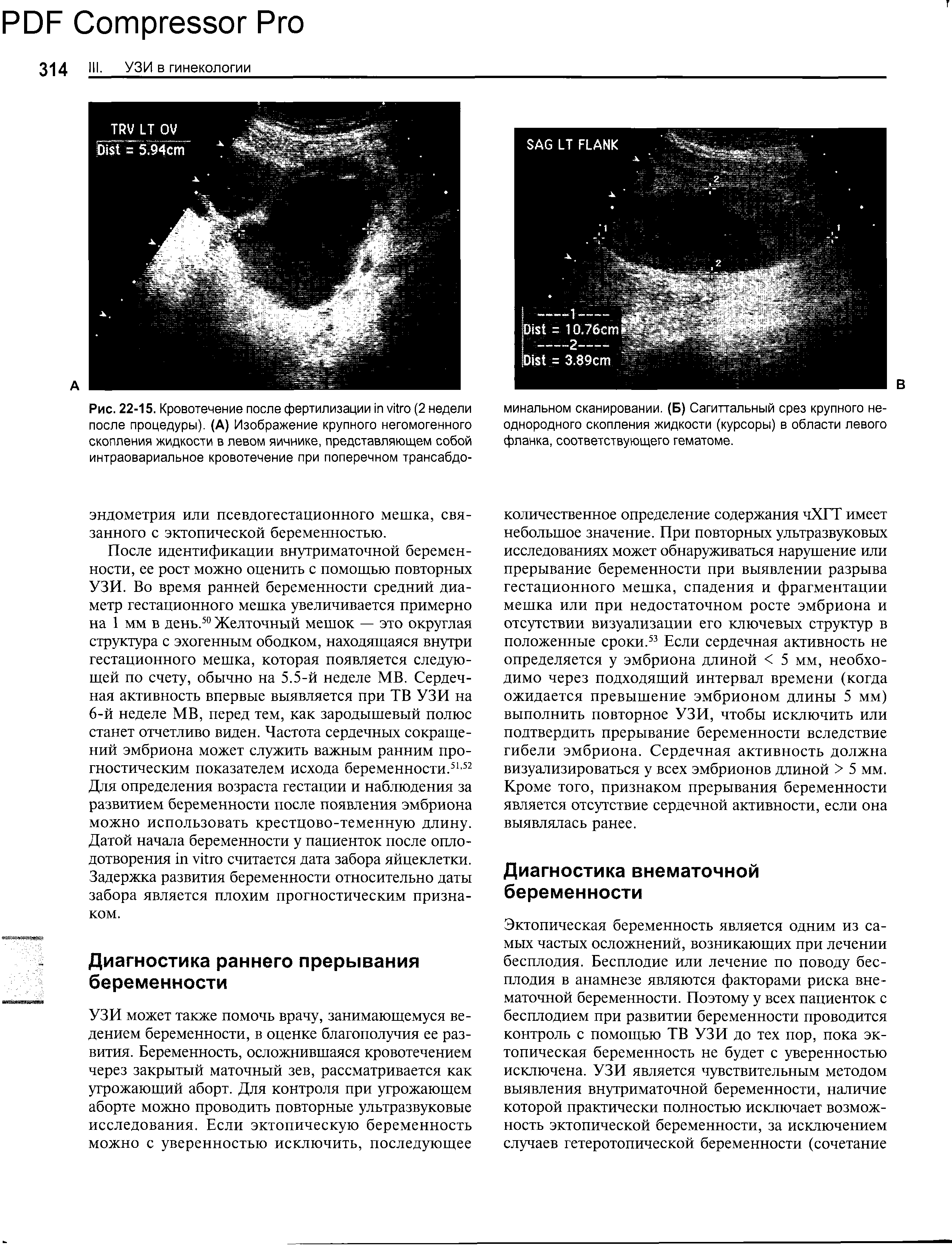 Рис. 22-15. Кровотечение после фертилизации (2 недели после процедуры). (А) Изображение крупного негомогенного скопления жидкости в левом яичнике, представляющем собой интраовариальное кровотечение при поперечном трансабдо-...