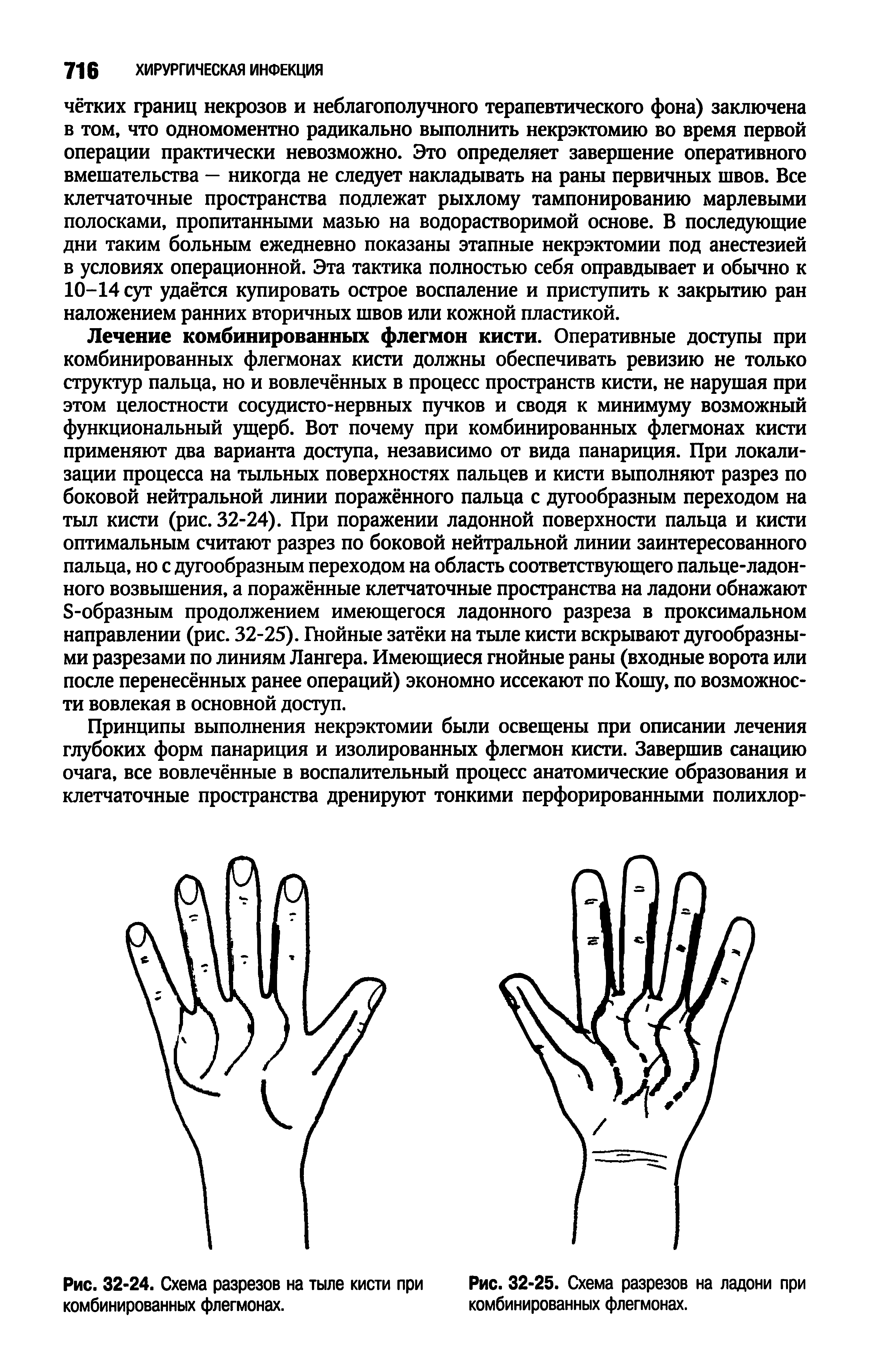 Рис. 32-24. Схема разрезов на тыле кисти при Рис. 32-25. Схема разрезов на ладони при комбинированных флегмонах. комбинированных флегмонах.