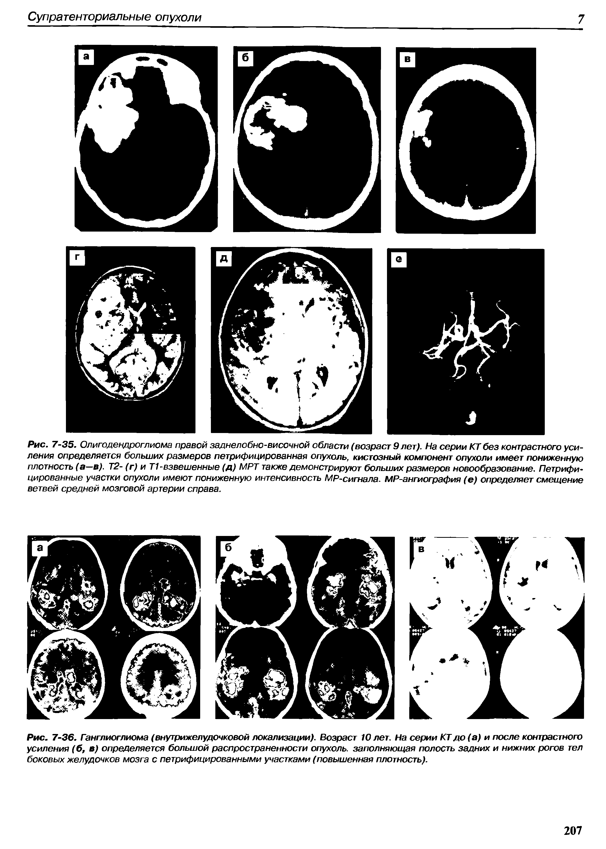 Рис. 7-36. Ганглиоглиома (внутрижелудочковой локализации). Возраст 10 лет. На серии КТ до (а) и после контрастного усиления (6, в) определяется большой распространенности опухоль, заполняющая полость задних и нижних рогов тел боковых желудочков мозга с петрифицированными участками (повышенная плотность).