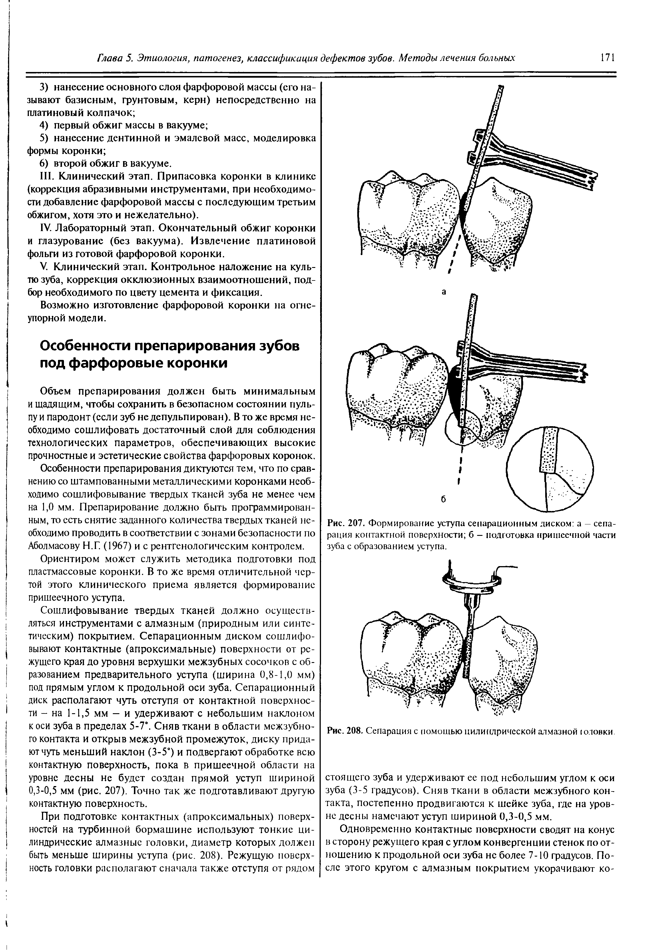 Рис. 207. Формирование уступа сепарационным диском а - сепарация контактной поверхности б — подготовка пришеечной части зуба с образованием уступа.