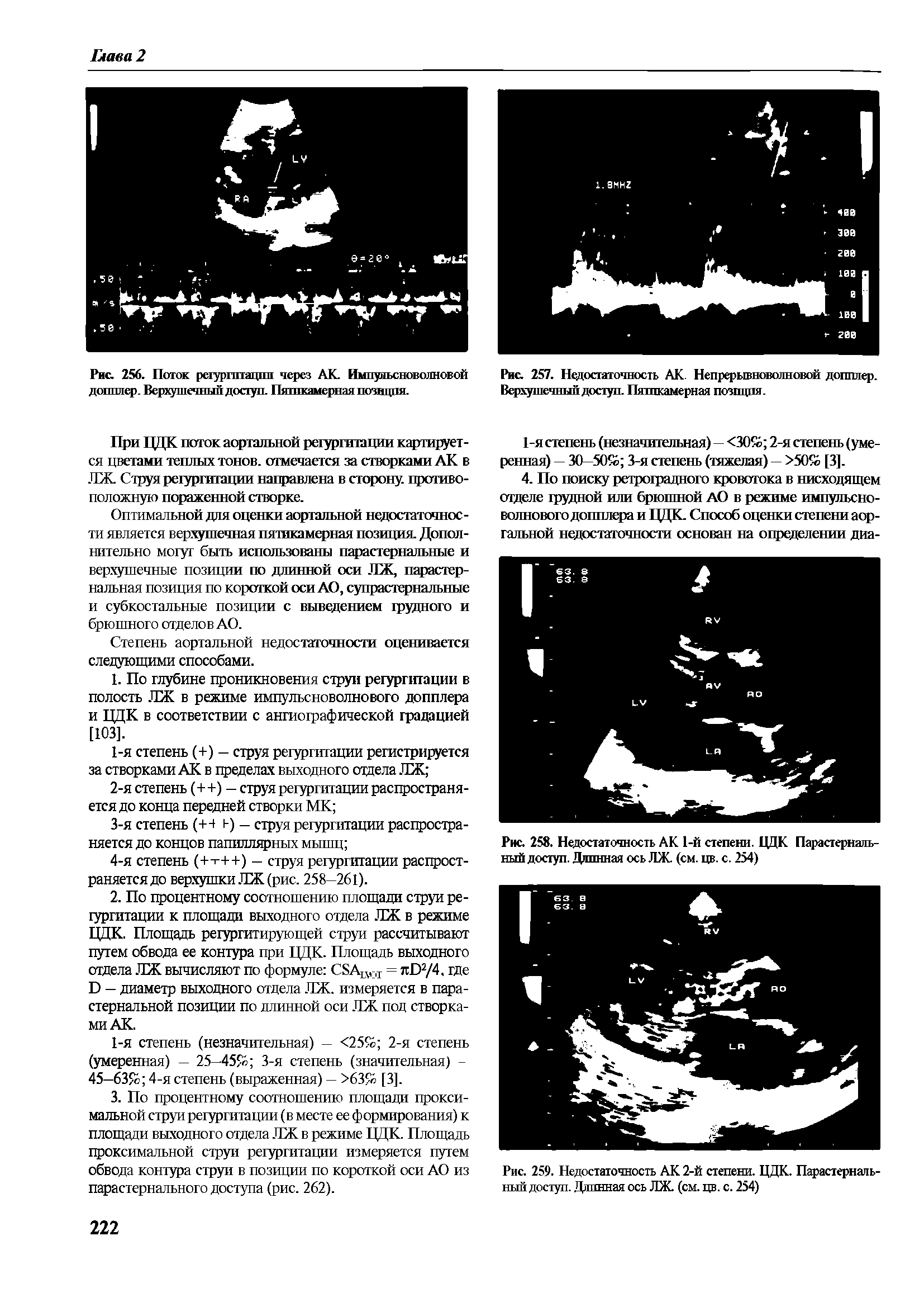 Рис. 257. Недостаточность АК. Непрерывноволновой допплер. Верхушечный доступ. Пяшкамерная позиция.