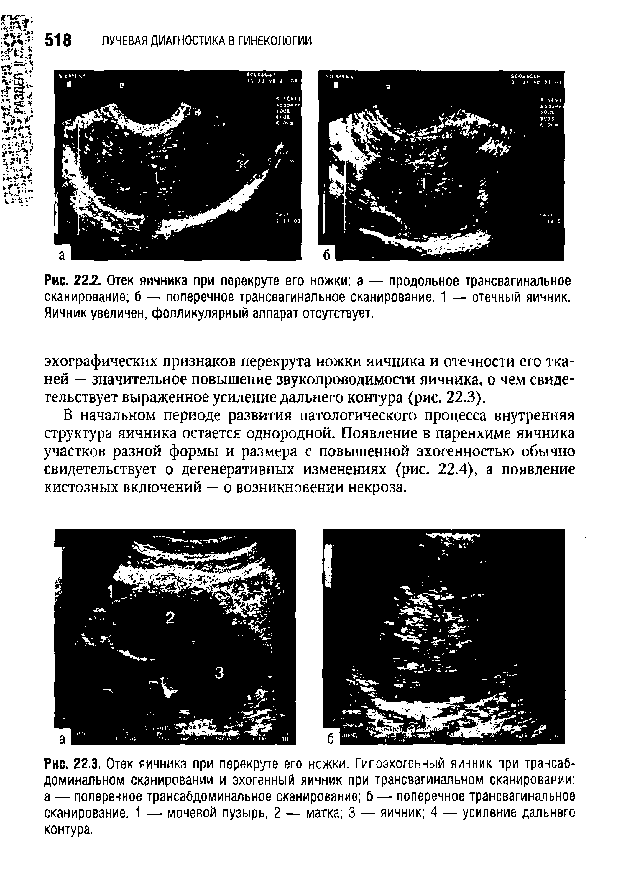 Рис. 22.3. Отек яичника при перекруте его ножки. Гипоэхогенный яичник при трансабдоминальном сканировании и эхогенный яичник при трансвагинальном сканировании а — поперечное трансабдоминальное сканирование б — поперечное трансвагинальное сканирование. 1 — мочевой пузырь, 2 — матка 3 — яичник 4 — усиление дальнего контура.