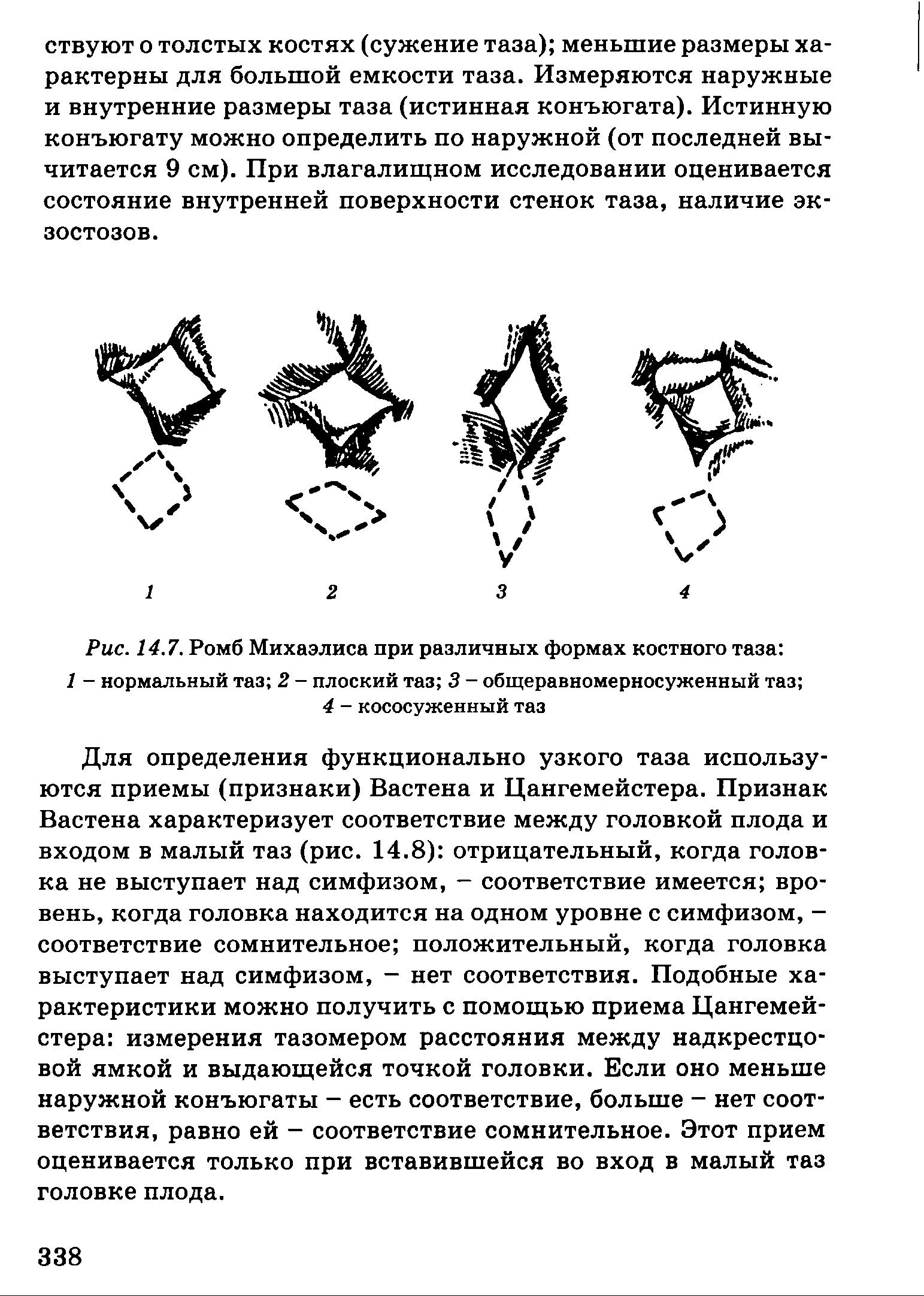 Рис. 14.7. Ромб Михаэлиса при различных формах костного таза 1 - нормальный таз 2 - плоский таз 3 - общеравномерносуженный таз ...