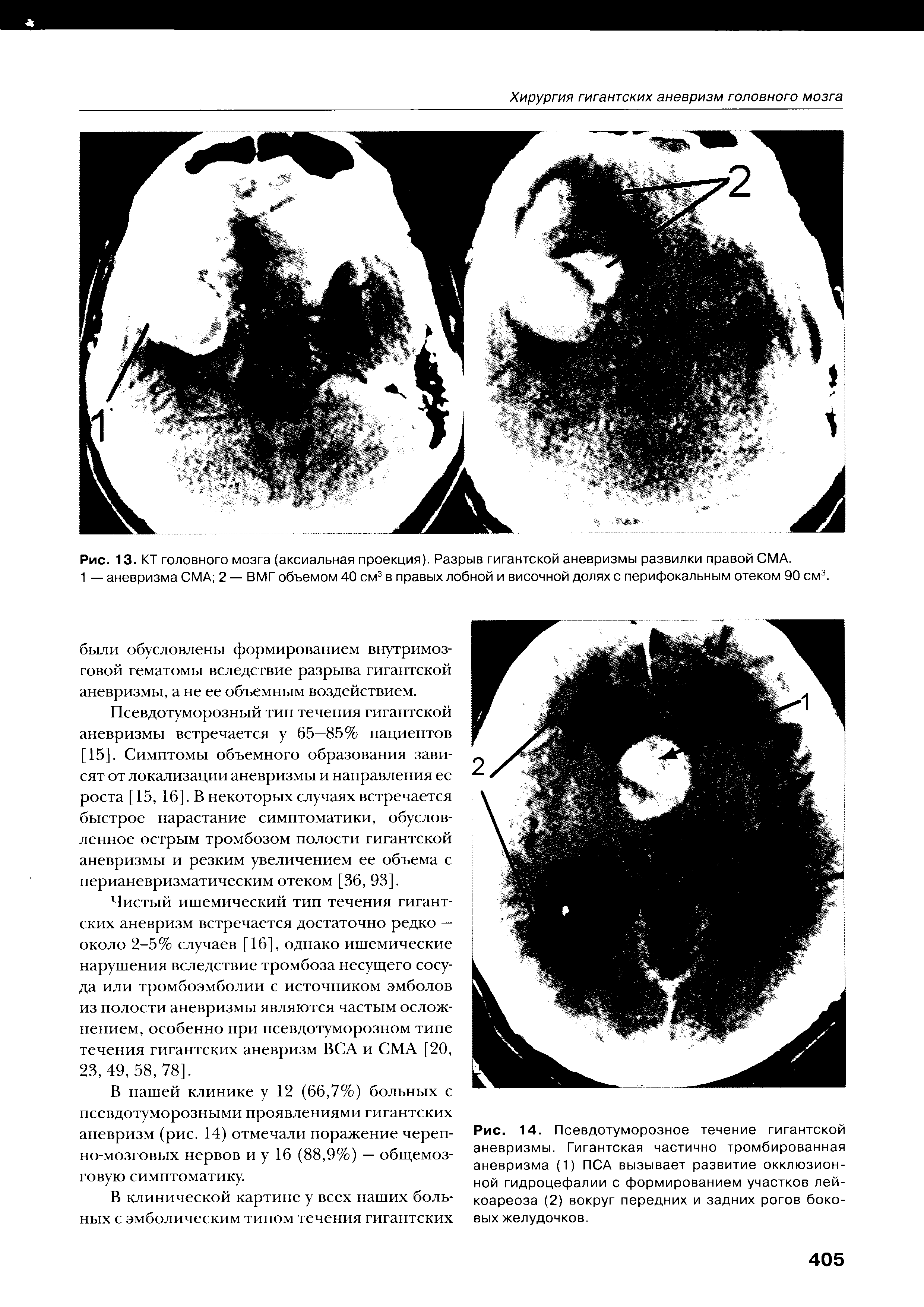 Рис. 14. Псевдотуморозное течение гигантской аневризмы. Гигантская частично тромбированная аневризма (1) ПСА вызывает развитие окклюзионной гидроцефалии с формированием участков лей-коареоза (2) вокруг передних и задних рогов боковых желудочков.