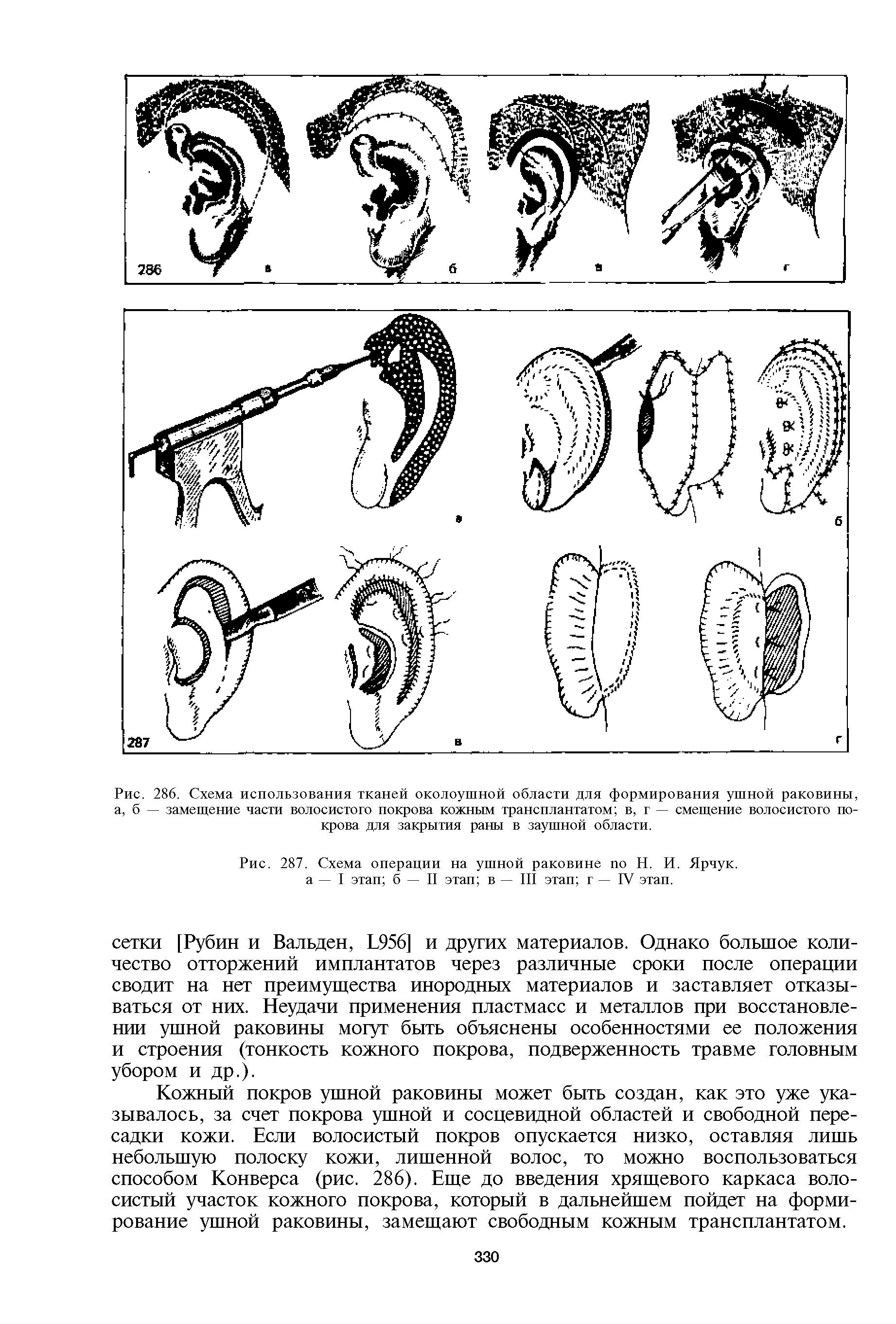 Рис. 287. Схема операции на ушной раковине по Н. И. Ярчук. а — I этап б — II этап в — III этап г — IV этап.