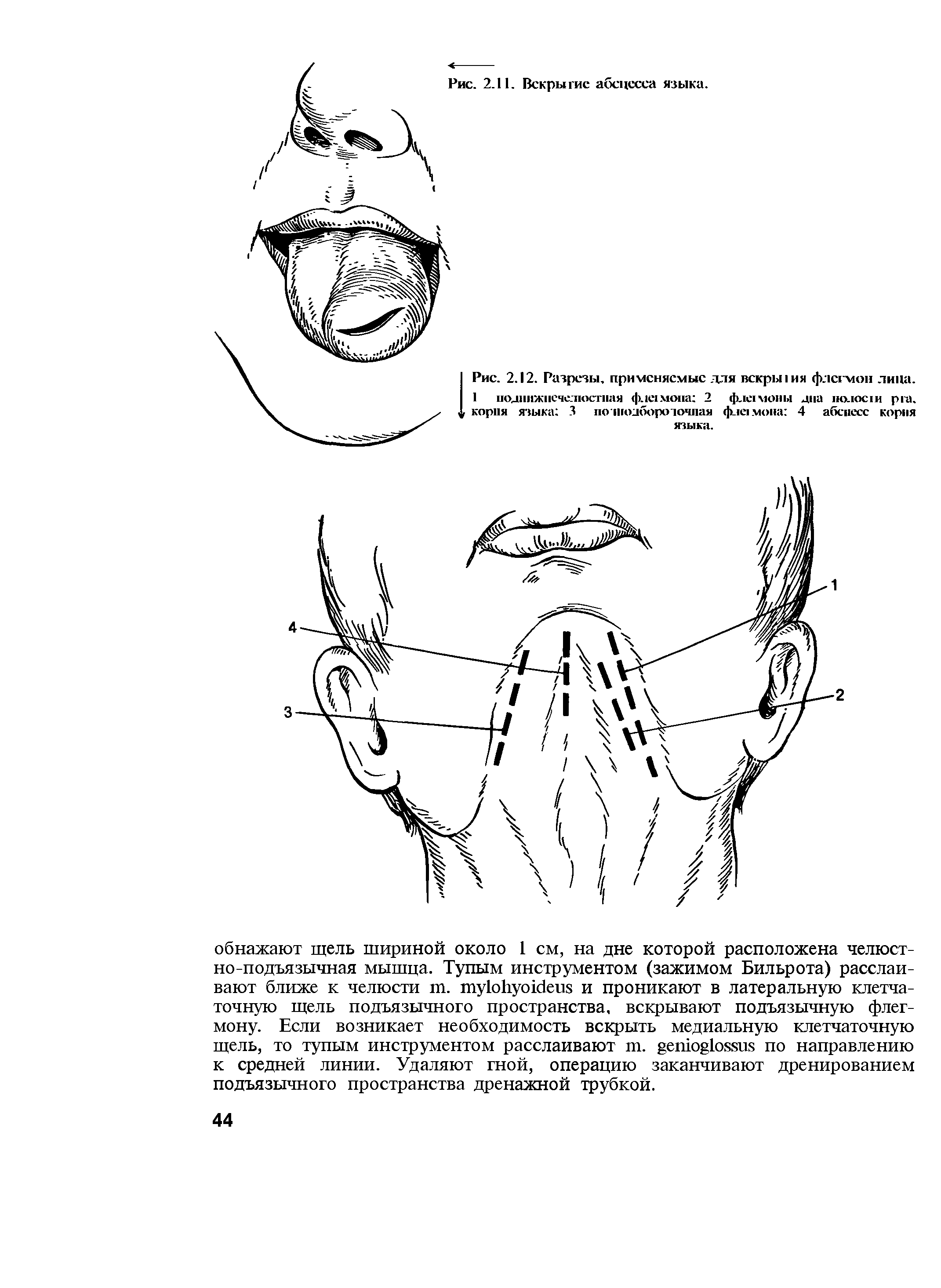 Рис. 2.12. Разрезы, применяемые для вскрьпия флегмон лица. I поднижнечелюстная флегмона 2 флнмоны дна . корпя языка 3 по нюдбороточная флегмона 4 абсцесс корня языка.