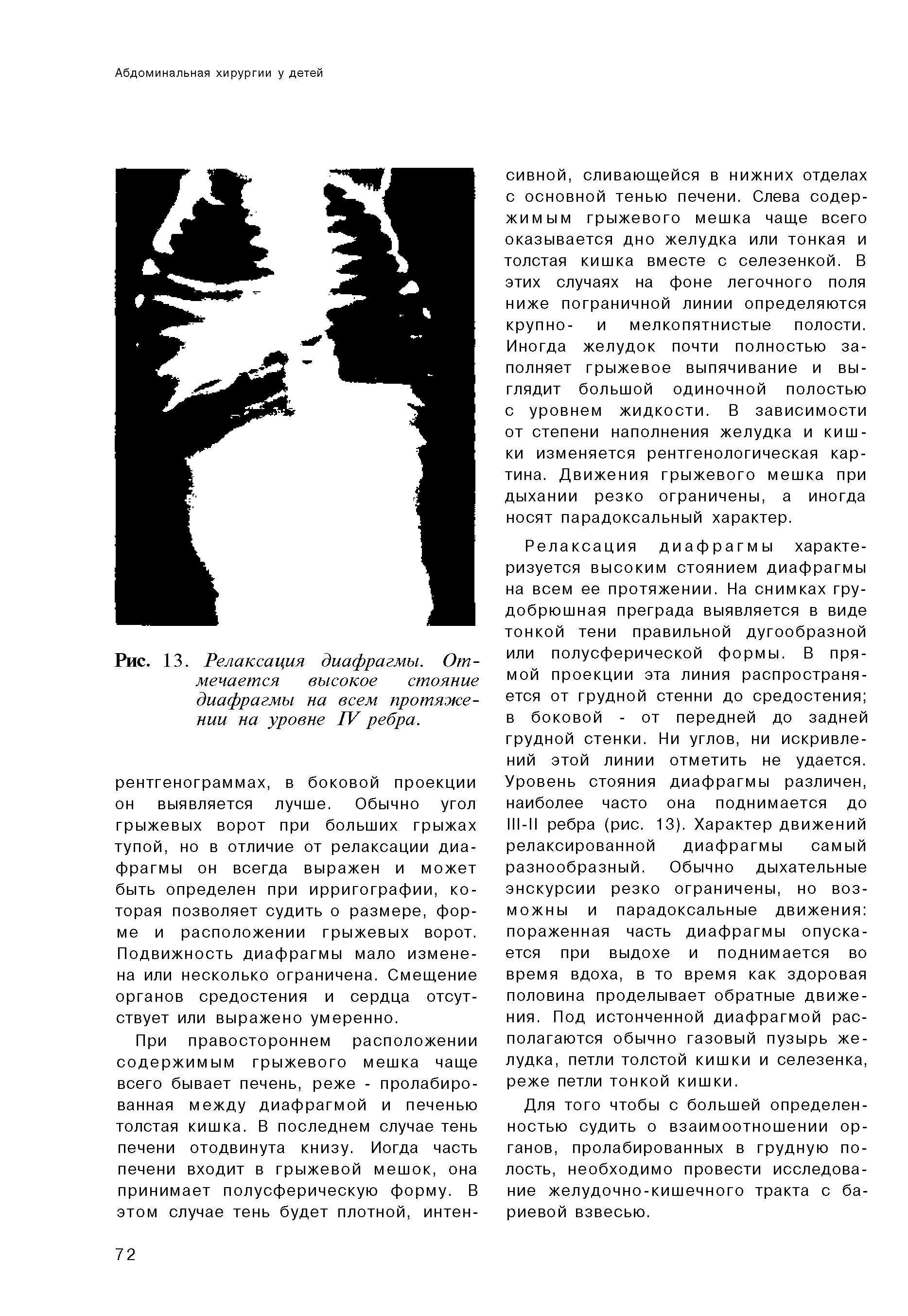 Рис. 13. Релаксация диафрагмы. Отмечается высокое стояние диафрагмы на всем протяжении на уровне IV ребра.