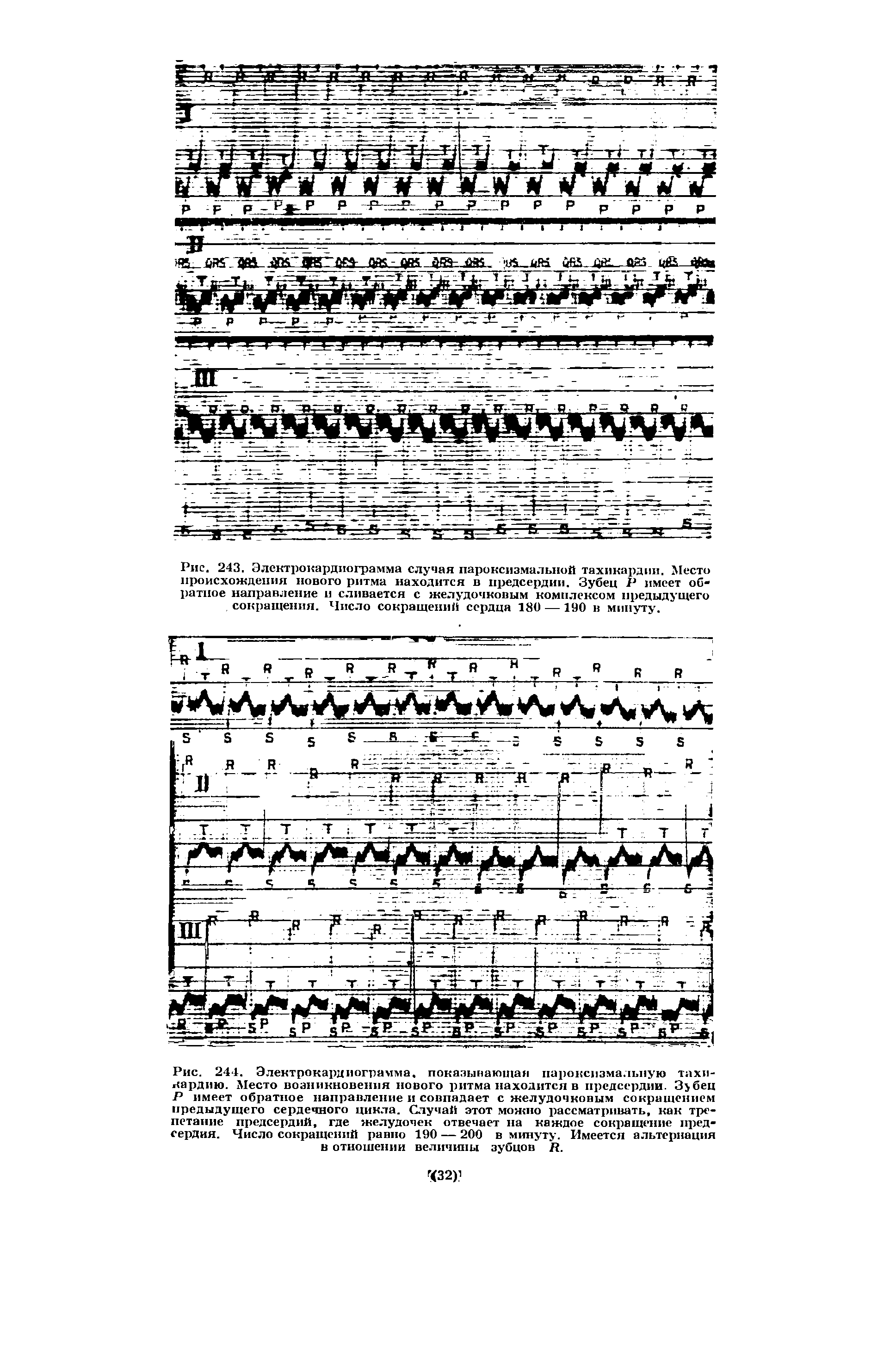 Рис. 243, Электрокардиограмма случая пароксизмальной тахикардии. Место происхождения нового ритма находится в предсердии. Зубец Р имеет обратное направление и сливается с желудочковым комплексом предыдущего сокращения. Число сокращений сердца 180 —190 в минуту.