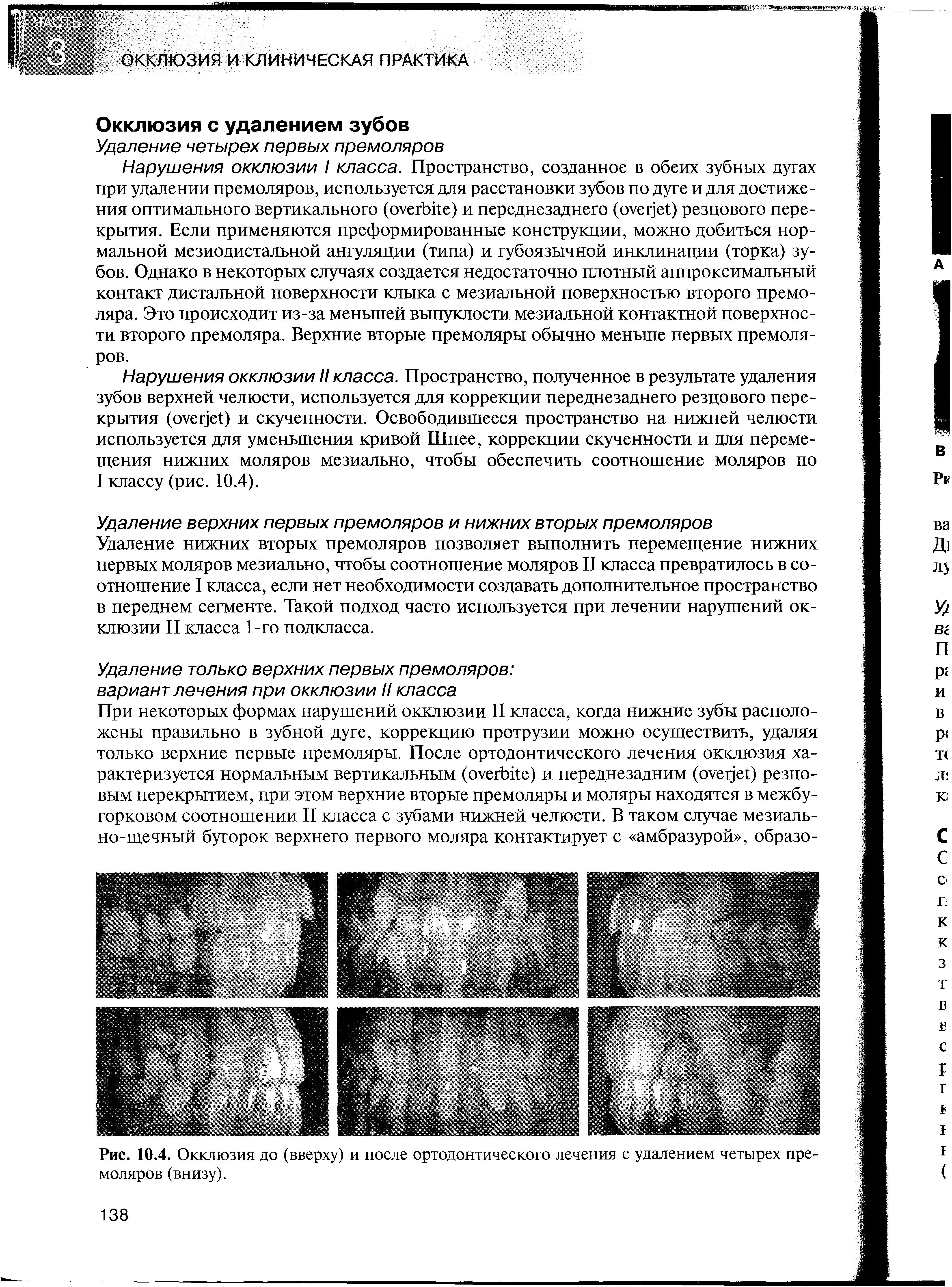 Рис. 10.4. Окклюзия до (вверху) и после ортодонтического лечения с удалением четырех премоляров (внизу).