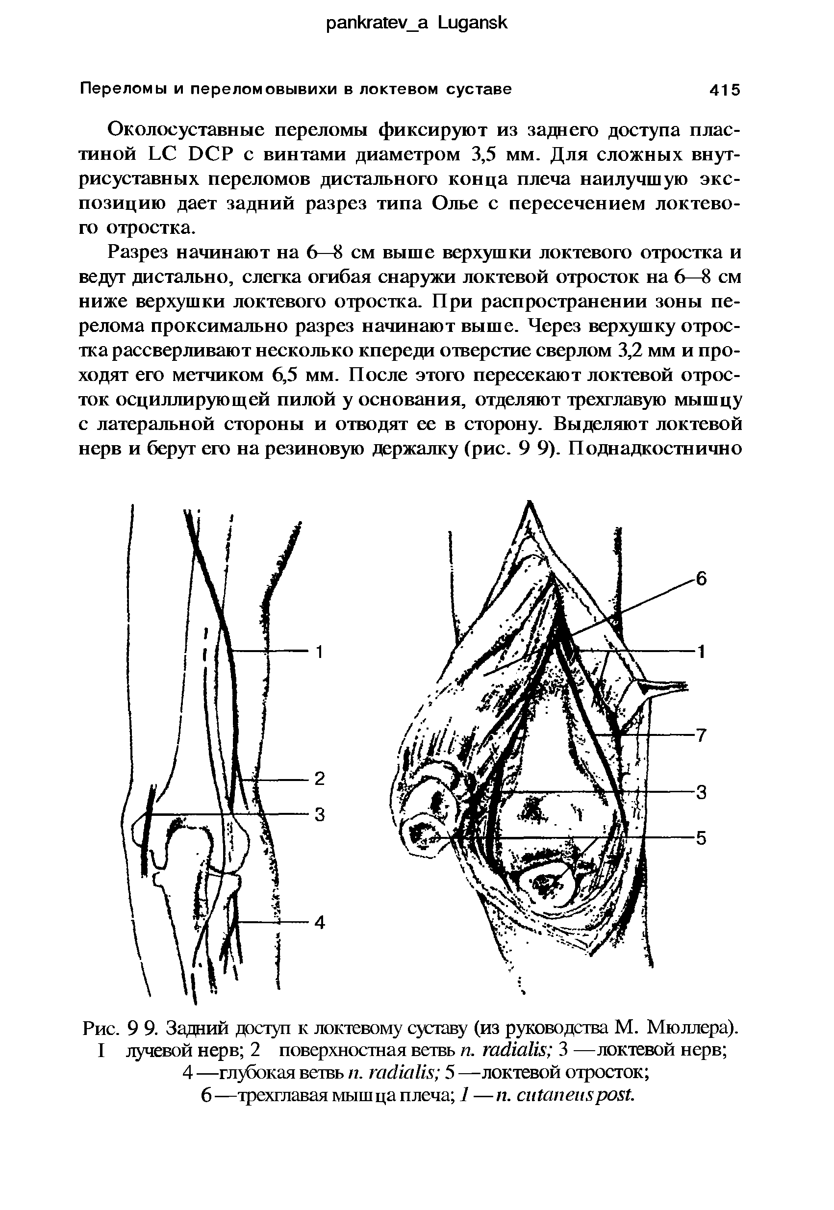 Рис. 9 9. Задний доступ к локтевому суставу (из руководства М. Мюллера). I лучевой нерв 2 поверхностная ветвь п. гасИаИя 3 —локтевой нерв ...