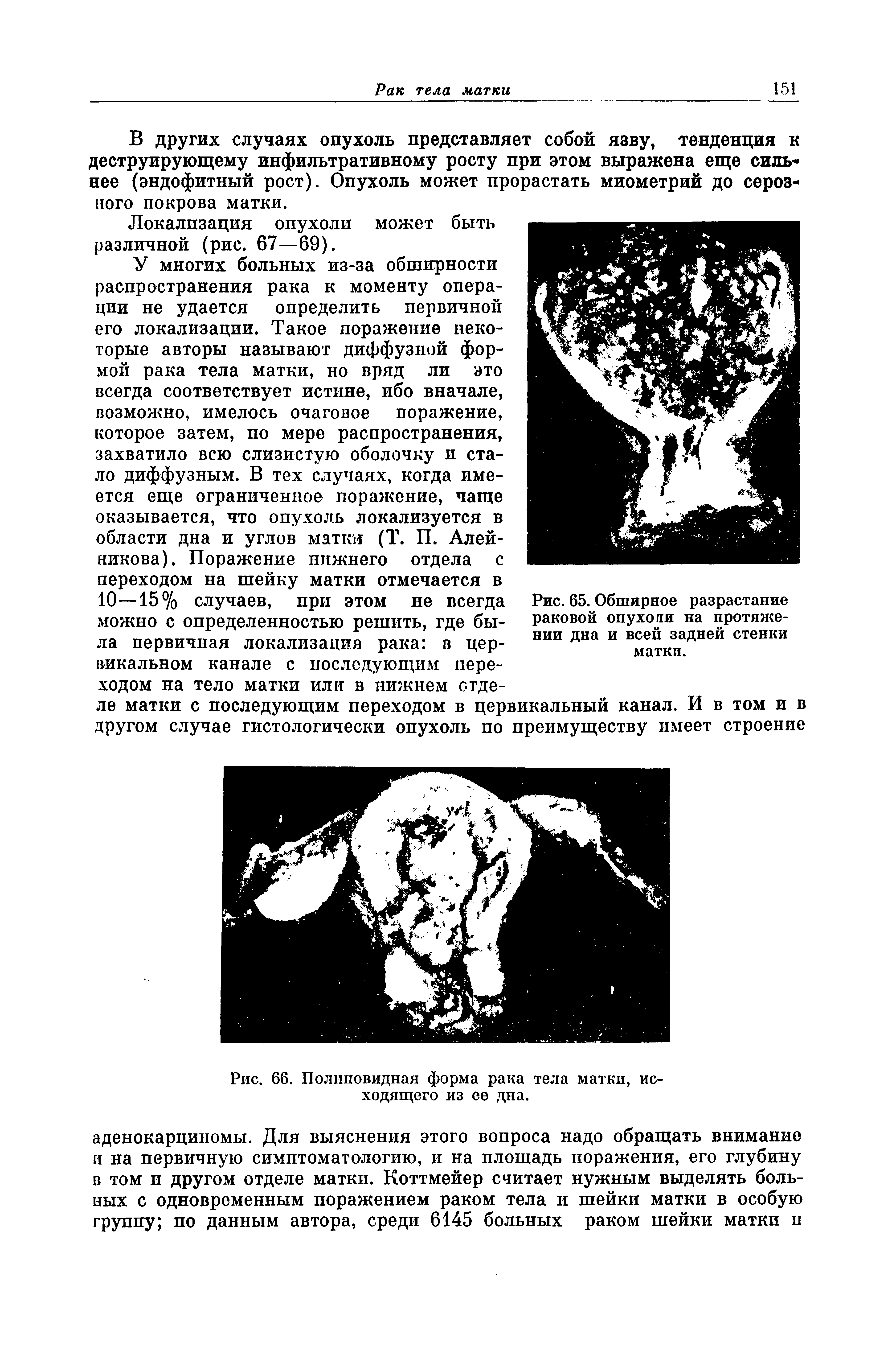 Рис. 66. Полпповидная форма рака тела матки, исходящего из ее дна.