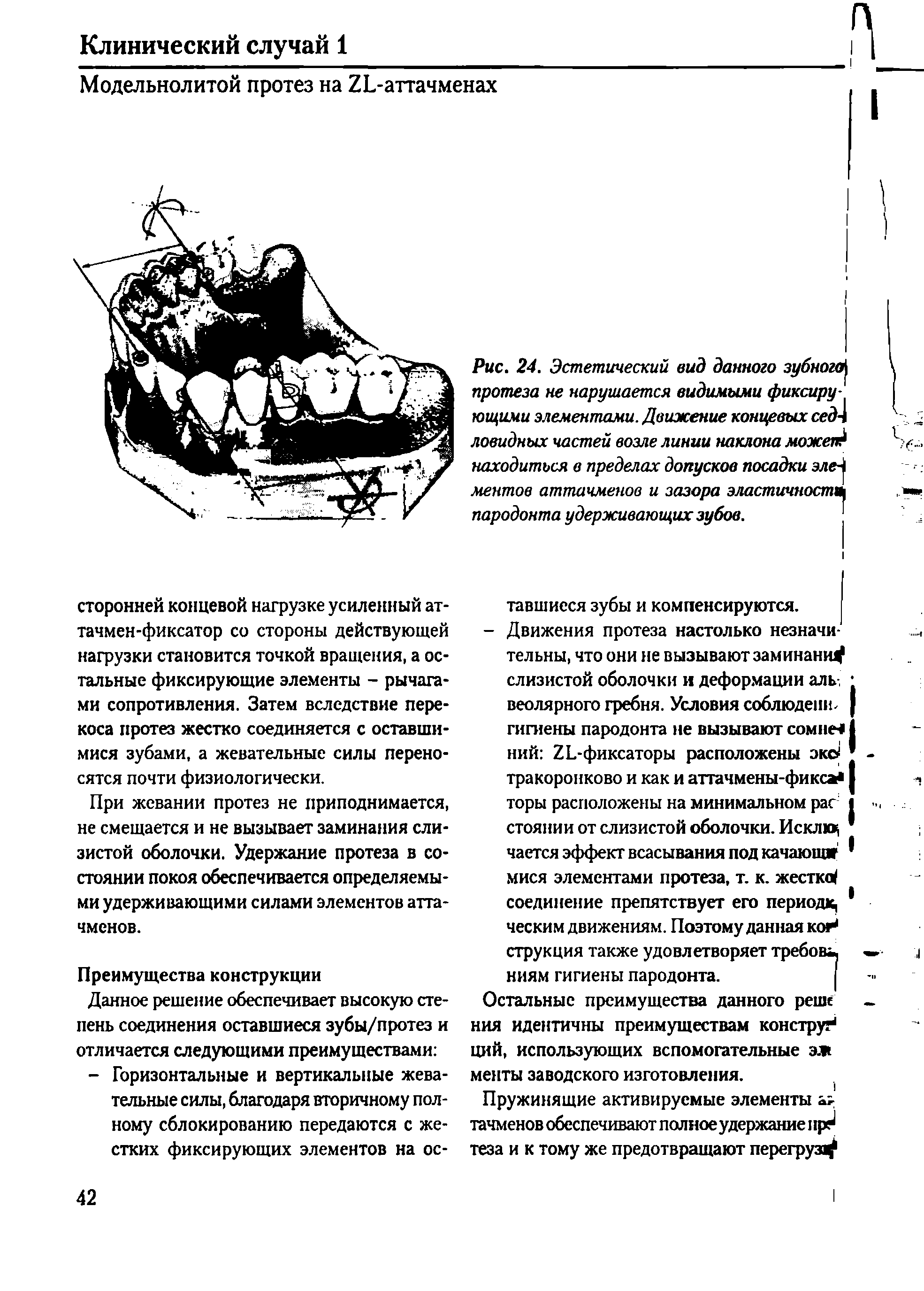 Рис. 24. Эстетический вид данного зубного протеза не нарушается видимыми фиксирующими элементами. Движение концевых сед4 ловидных частей возле линии наклона можеп находиться в пределах допусков посадки ментов аттачменов и зазора эластичност пародонта удерживающих зубов.