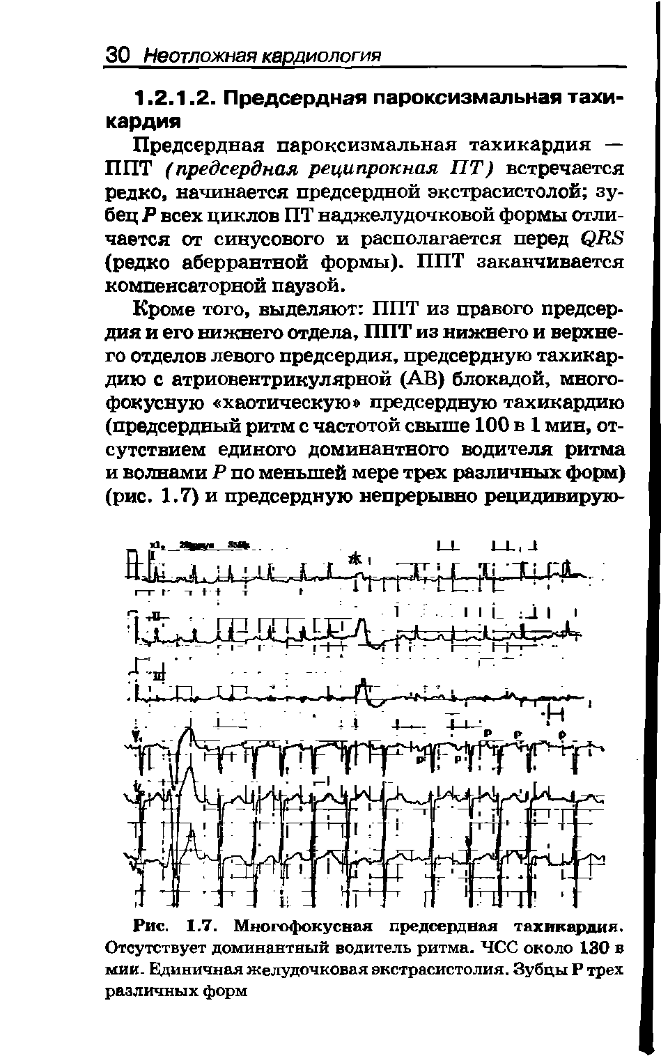 Рис. 1.7. Многофокусная предсердная тахикардия. Отсутствует доминантный водитель ритма. ЧСС около 130 в мии. Единичная желудочковая экстрасистолия. Зубцы Р трех различных форм...