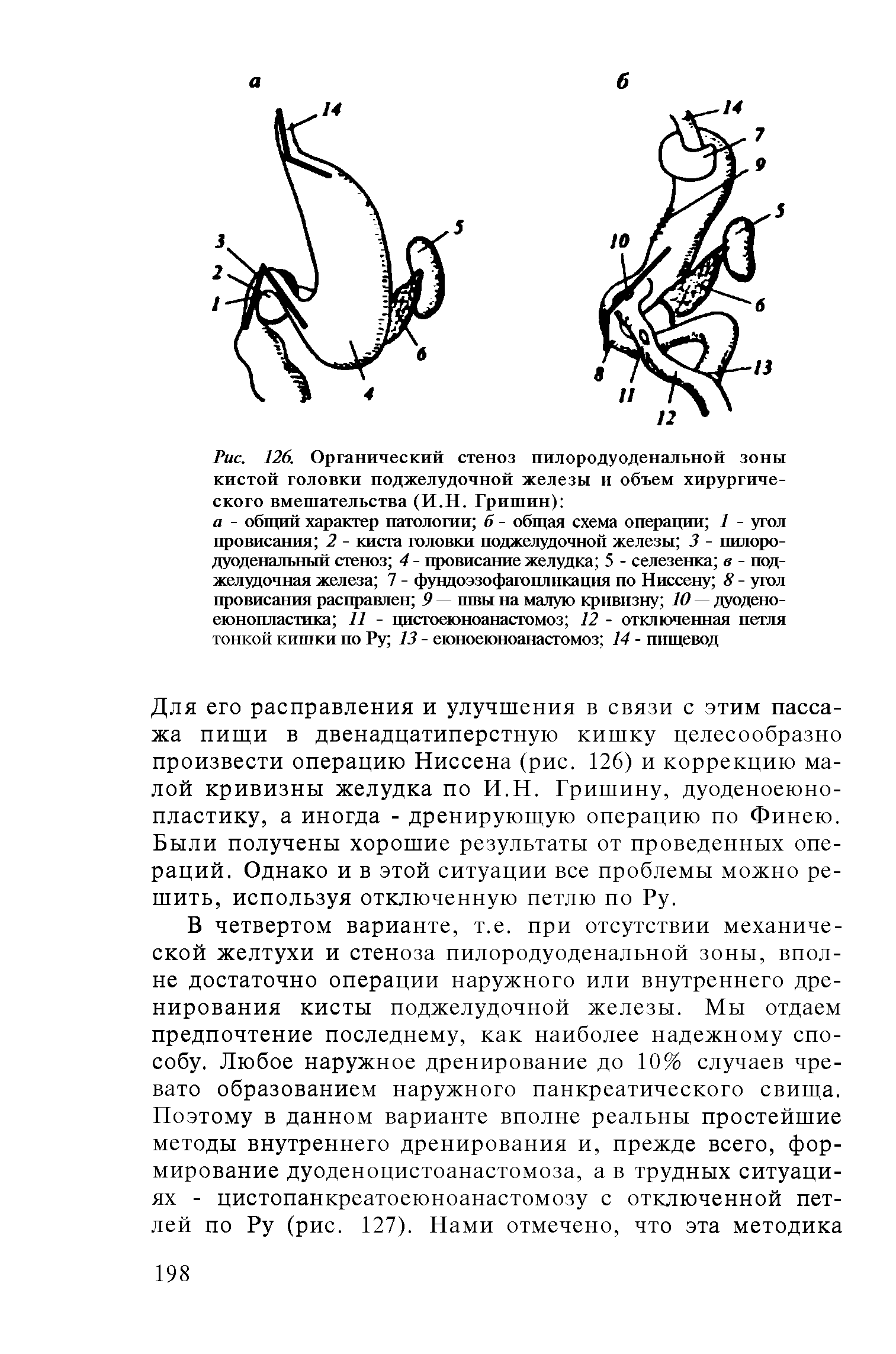 Рис. 126. Органический стеноз пилородуоденальной зоны кистой головки поджелудочной железы и объем хирургического вмешательства (И.Н. Гришин) ...