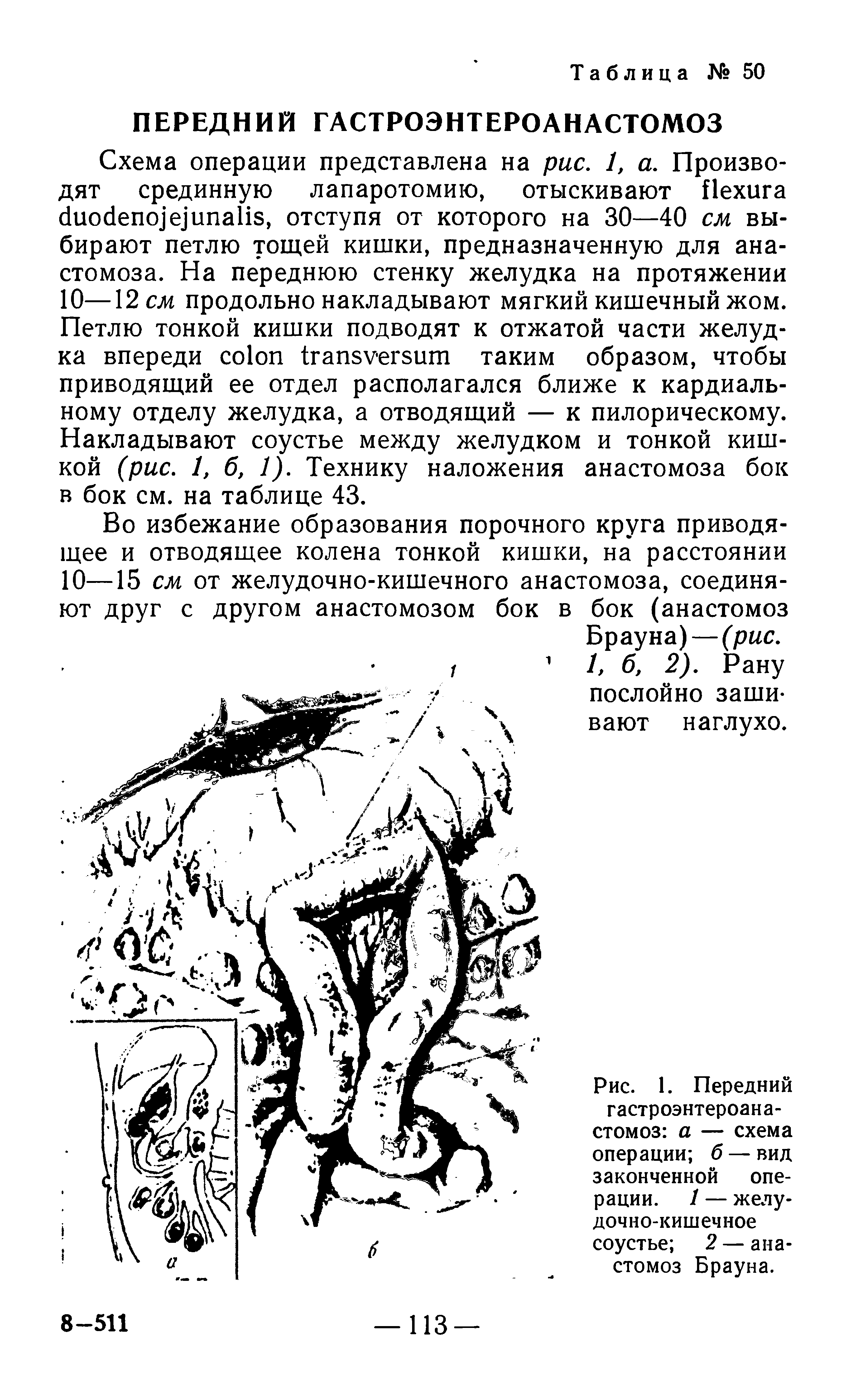 Рис. 1. Передний гастроэнтероанастомоз а — схема операции б — вид законченной операции. 1 — желудочно-кишечное соустье 2 — анастомоз Брауна.