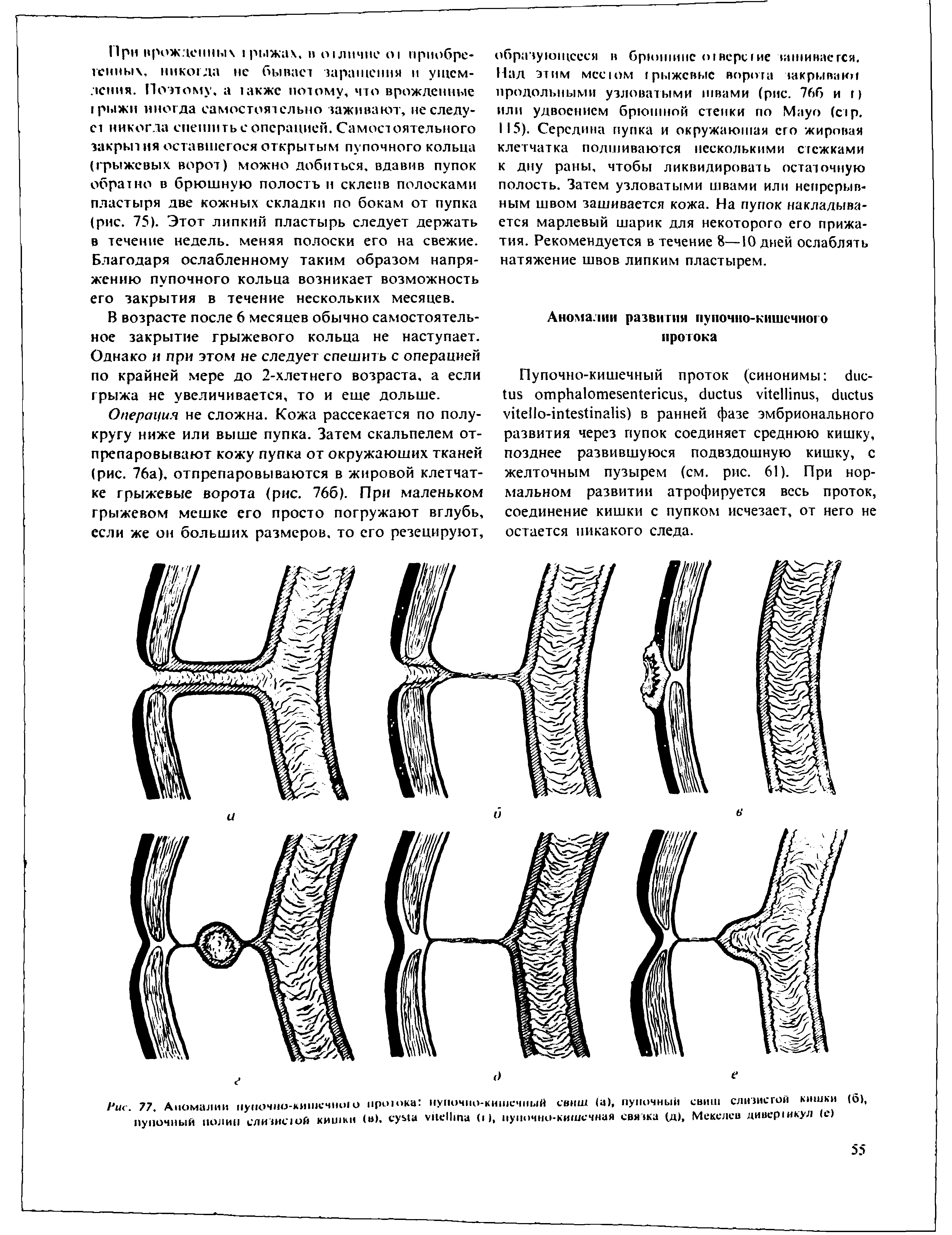 Рис. 77, Аномалии пупочно-кишечною проюка пупочно-кишечный сейш (а), пупочный сейш слизисгой кишки (б), пупочный полип слизистой кишки (и), сума унеПша О), пупочно-кишечная связка (д), Мекелев дивер1икул (е)...