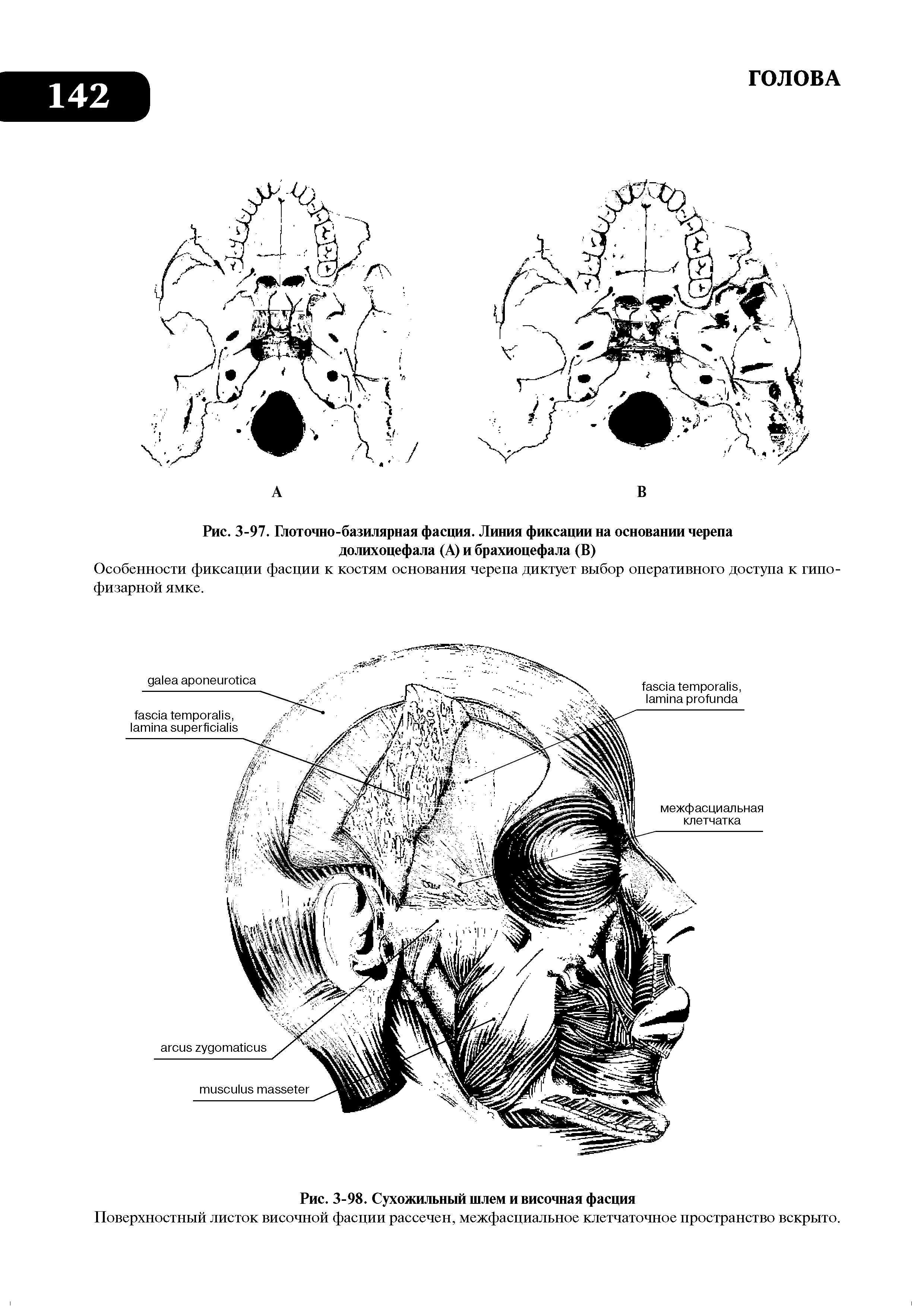 Рис. 3-97. Глоточно-базилярная фасция- Линия фиксации на основании черепа долихоцефала (А) и брахиоцефала (В)...