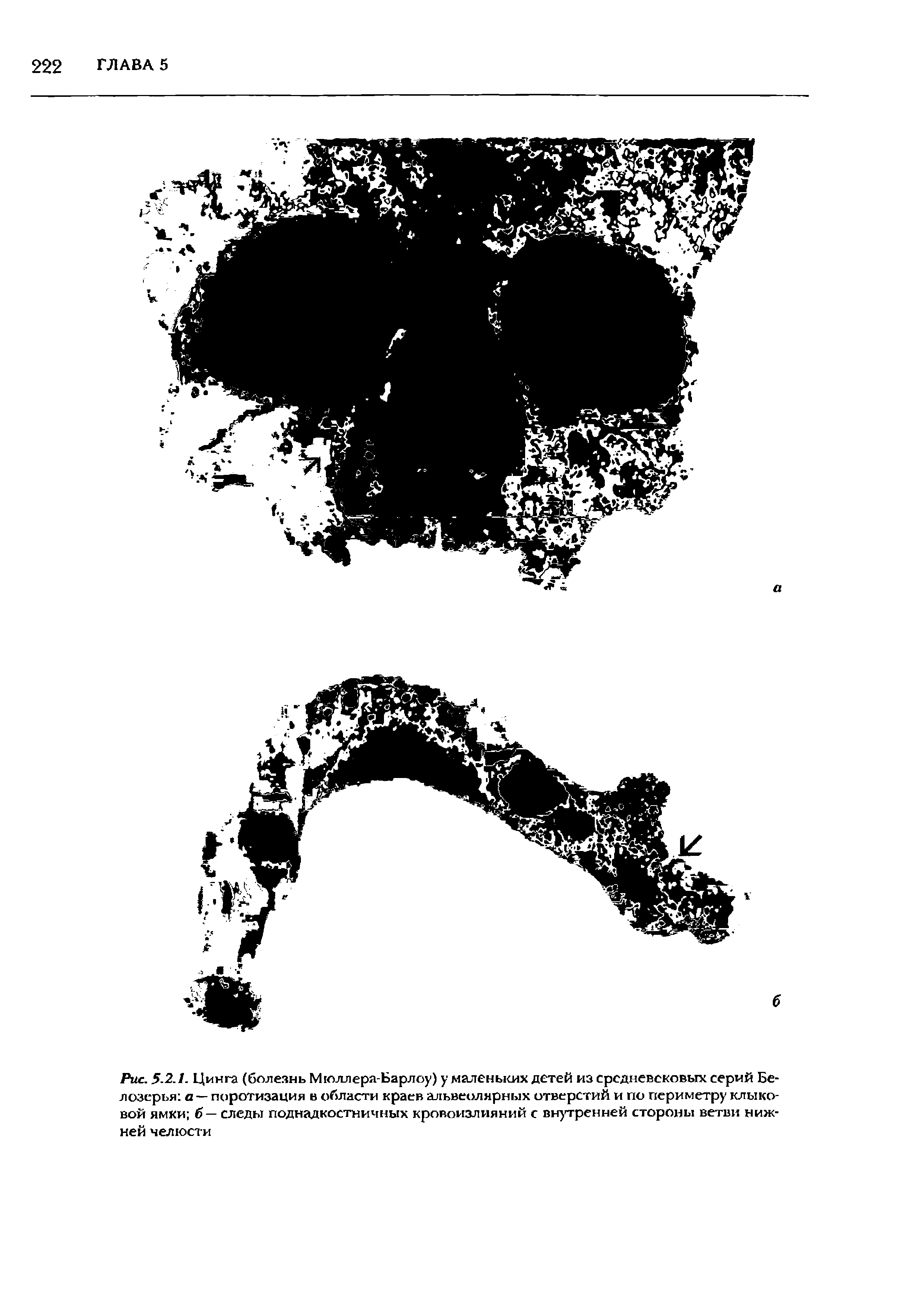 Рис. 5.2.1. Цинга (болезнь Мюллера-Барлоу) у маленьких детей из средневековых серий Бе-лозерья а — поротизация в области краев альвеолярных отверстий и по периметру клыковой ямки б — следы поднадкостничных кровоизлияний с внутренней стороны ветви нижней челюсти...