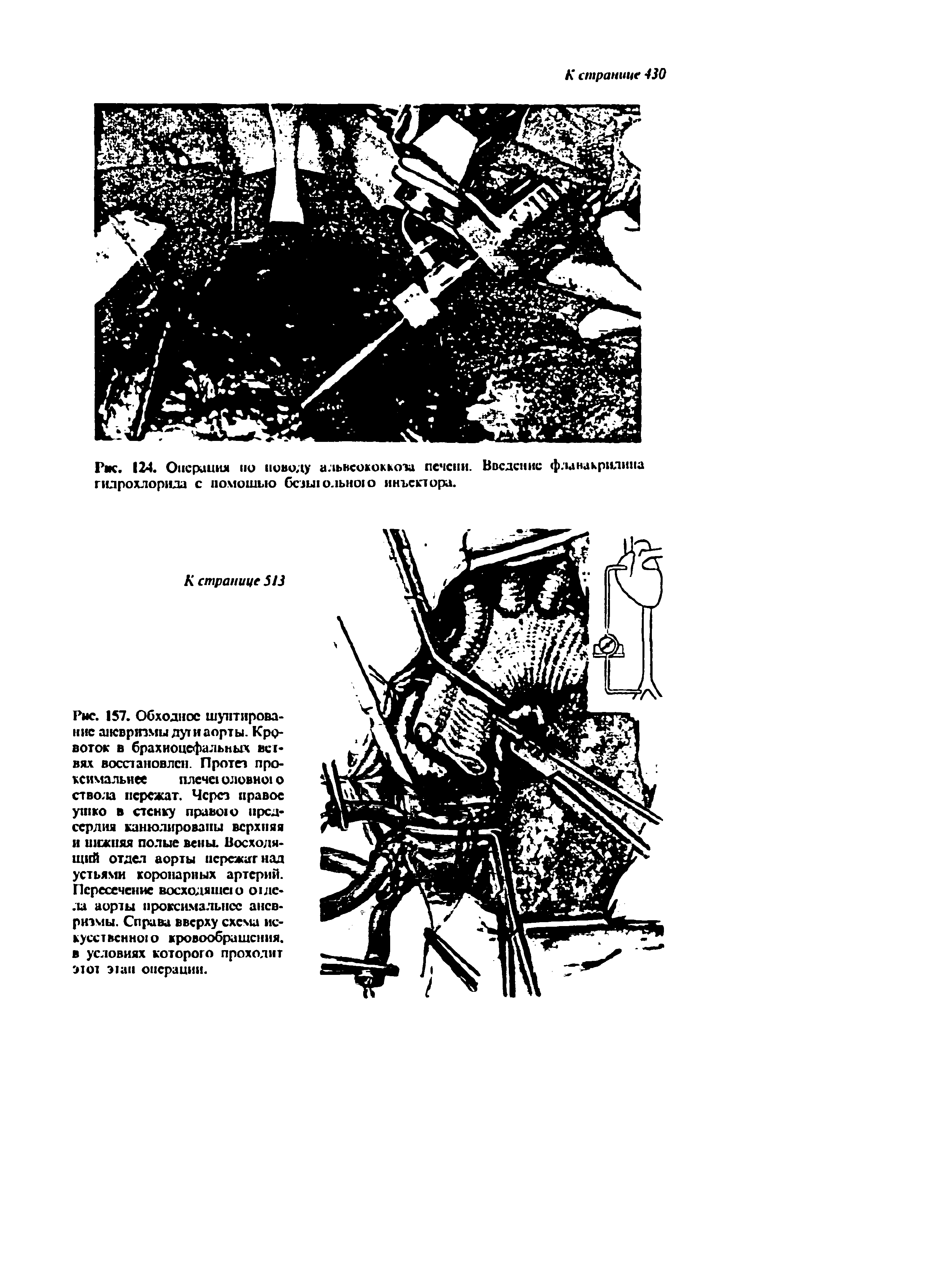 Рис. 124. Операция но поводу альвеококкоза печени. Введение фланакрилина гидрохлорида с номошыо безыюлытою инвестора.