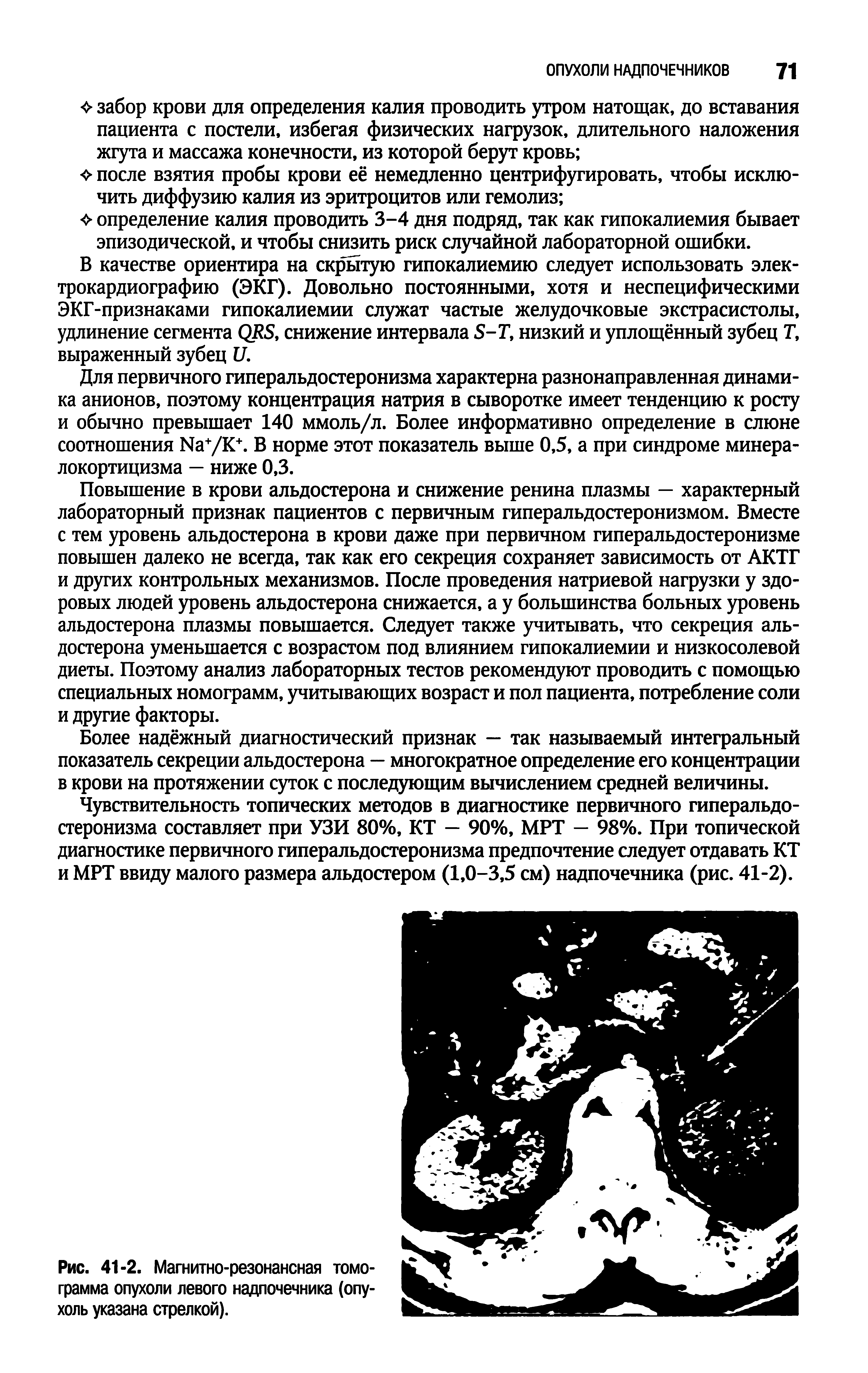 Рис. 41-2. Магнитно-резонансная томограмма опухоли левого надпочечника (опухоль указана стрелкой).