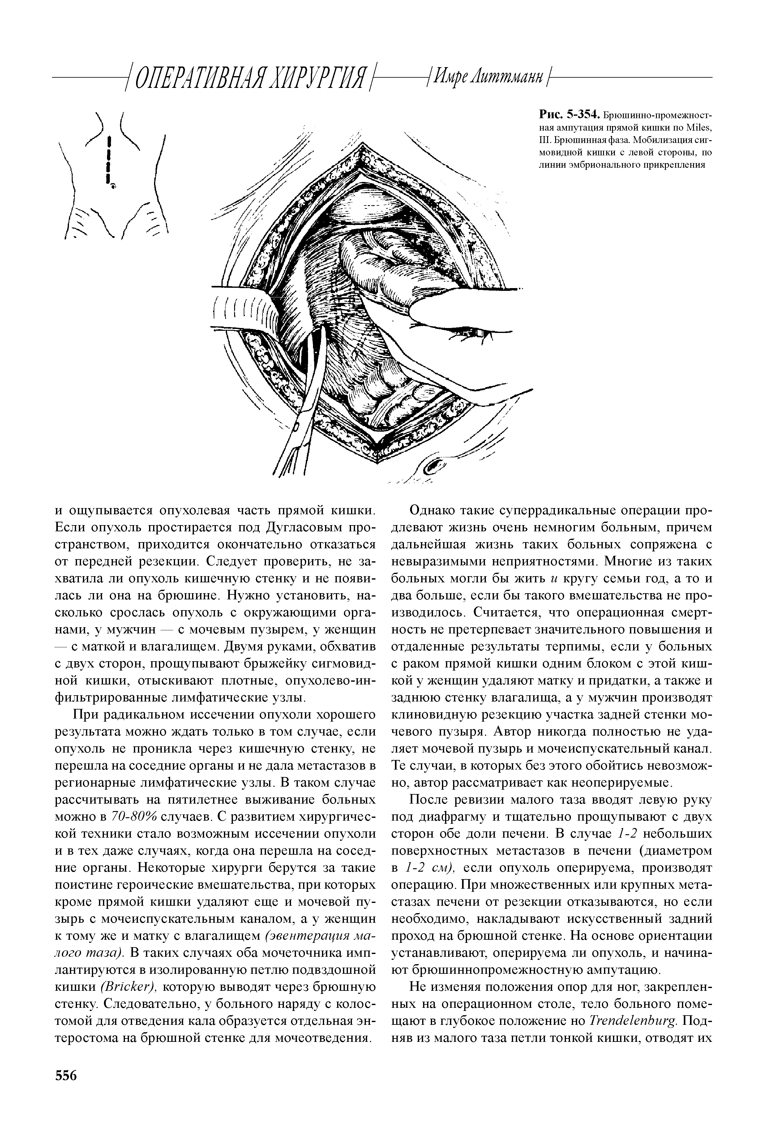 Рис. 5-354. Брюшинно-промежностная ампутация прямой кишки по M , III. Брюшинная фаза. Мобилизация сигмовидной кишки с левой стороны, по линии эмбрионального прикрепления...