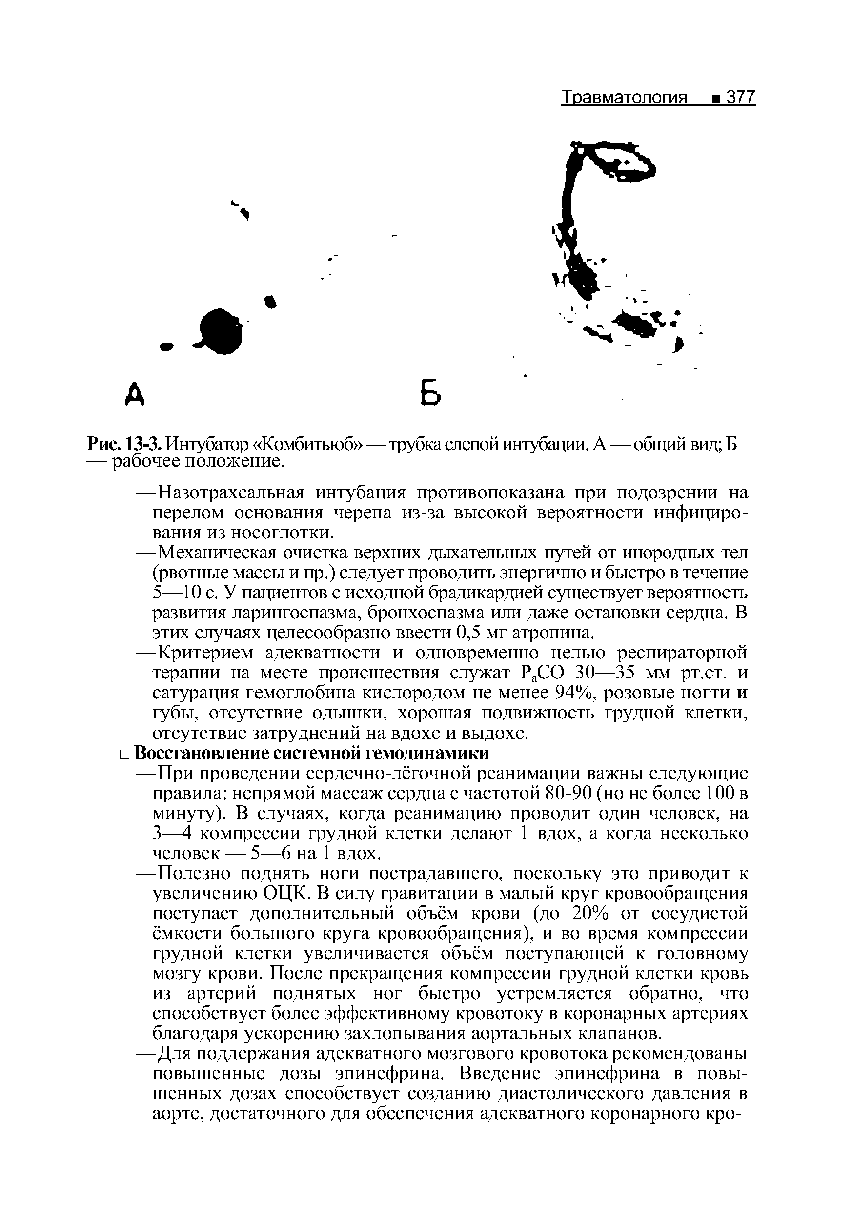 Рис. 13-3. Интубатор Комбитьюб —трубка слепой интубации. А—общий вид Б — рабочее положение.