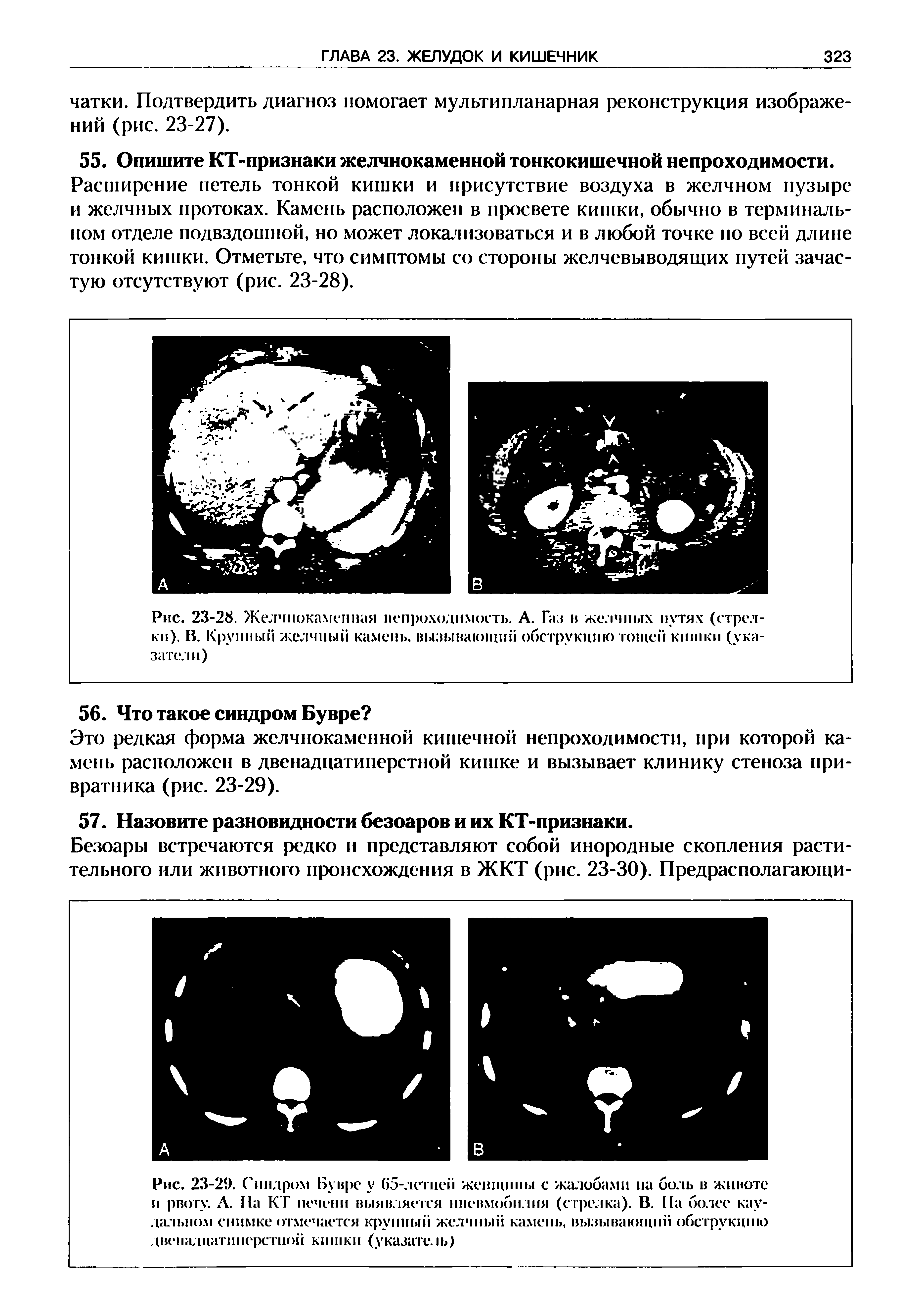Рис. 23-29. Синдром Ьувре у 65-летией женщины с жалобами на боль в животе и рвоту. Л. На КТ печени выявляется нневмобилия (стрелка). В. более каудальном снимке отмечается крупный желчный камень, вызывающий обструкцию двенадцатиперстной кишки (указате. )...