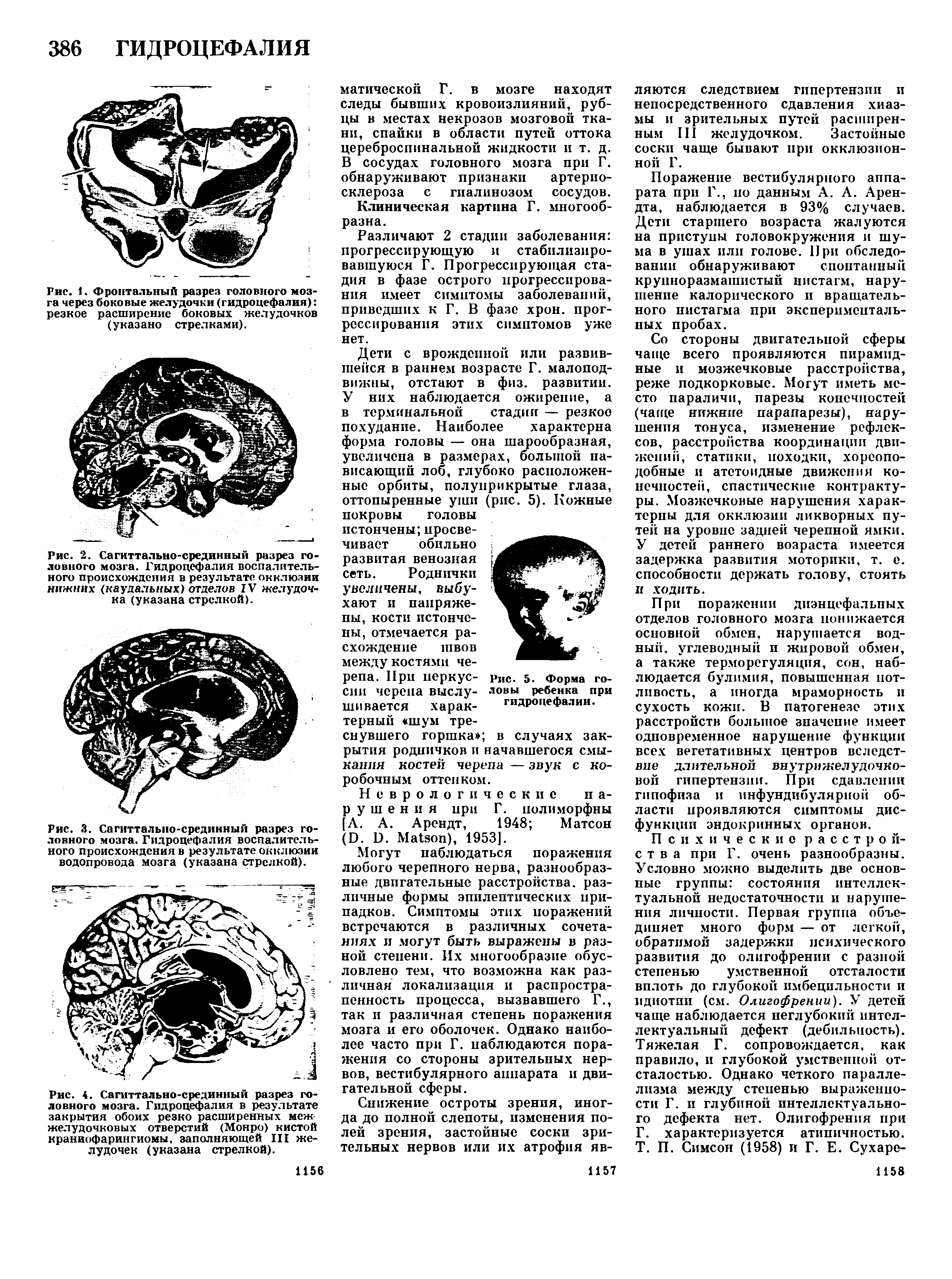 Рис. 2. Сагиттально-срединный разрез головного мозга. Гидроцефалия воспалительного происхождения в результате окклюзии нижних (каудальных) отделов IV желудочка (указана стрелкой).