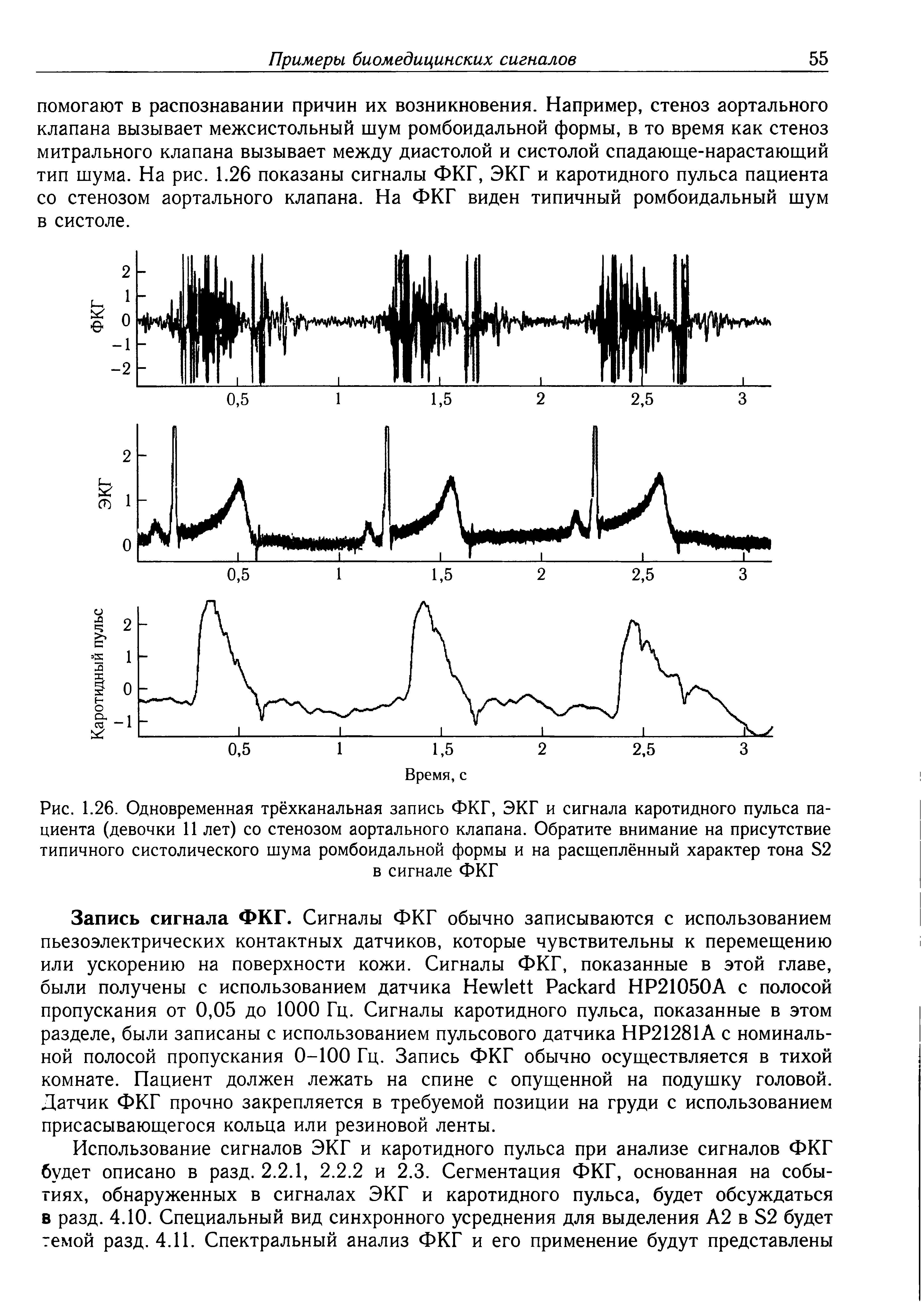 Рис. 1.26. Одновременная трёхканальная запись ФКГ, ЭКГ и сигнала каротидного пульса пациента (девочки 11 лет) со стенозом аортального клапана. Обратите внимание на присутствие типичного систолического шума ромбоидальной формы и на расщеплённый характер тона Б2 в сигнале ФКГ...