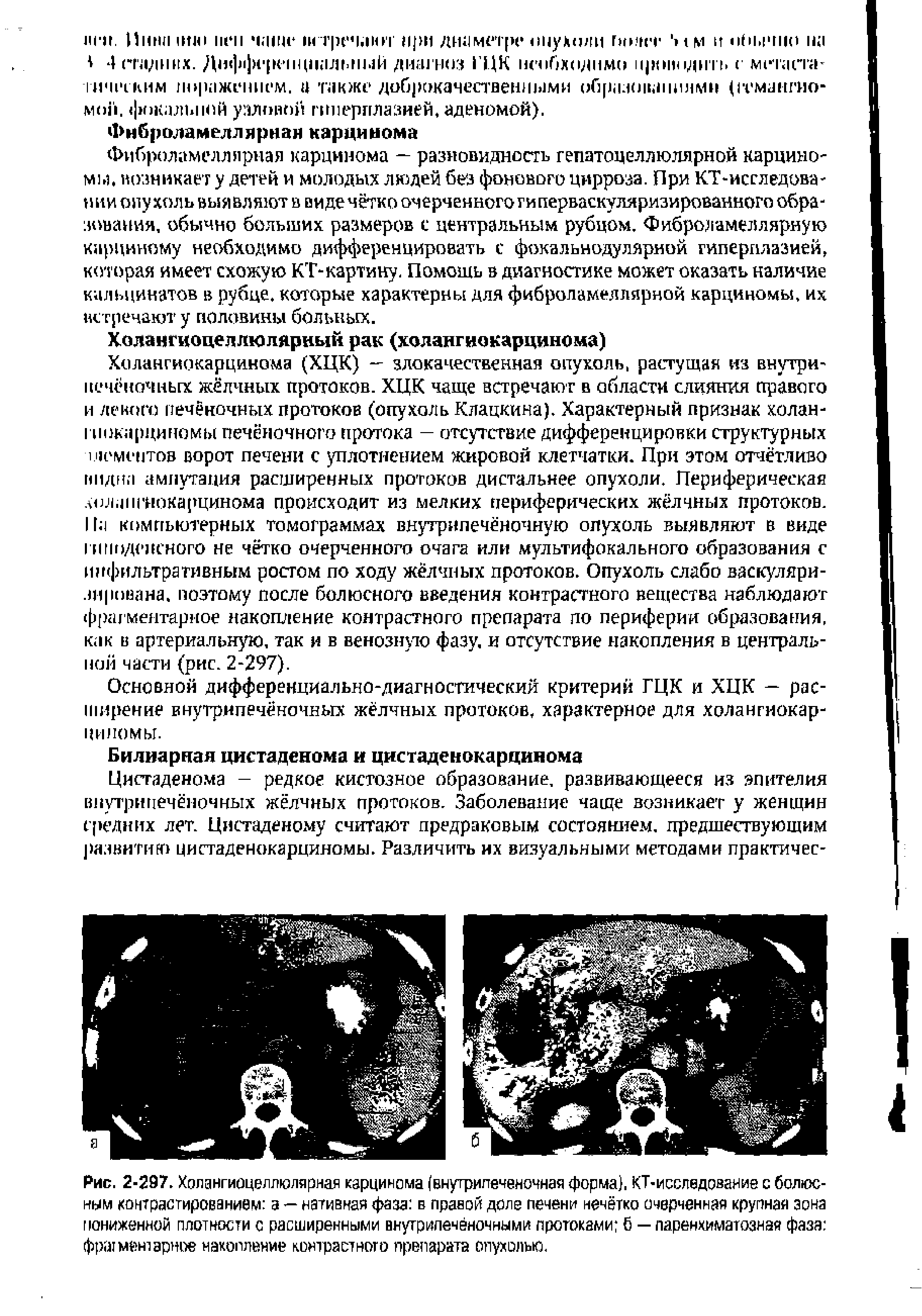 Рис. 2-297. Холангиоцеллюлярная карцинома (внутрипеченочная форма), КТ-исследование с болюсным контрастированием а — нативная фаза в правой доле печени нечётко очерченная крупная зона пониженной плотности с расширенными внутрипечёночными протоками б — паренхиматозная фаза фршментэрное накопление контрастного препарата опухолью.