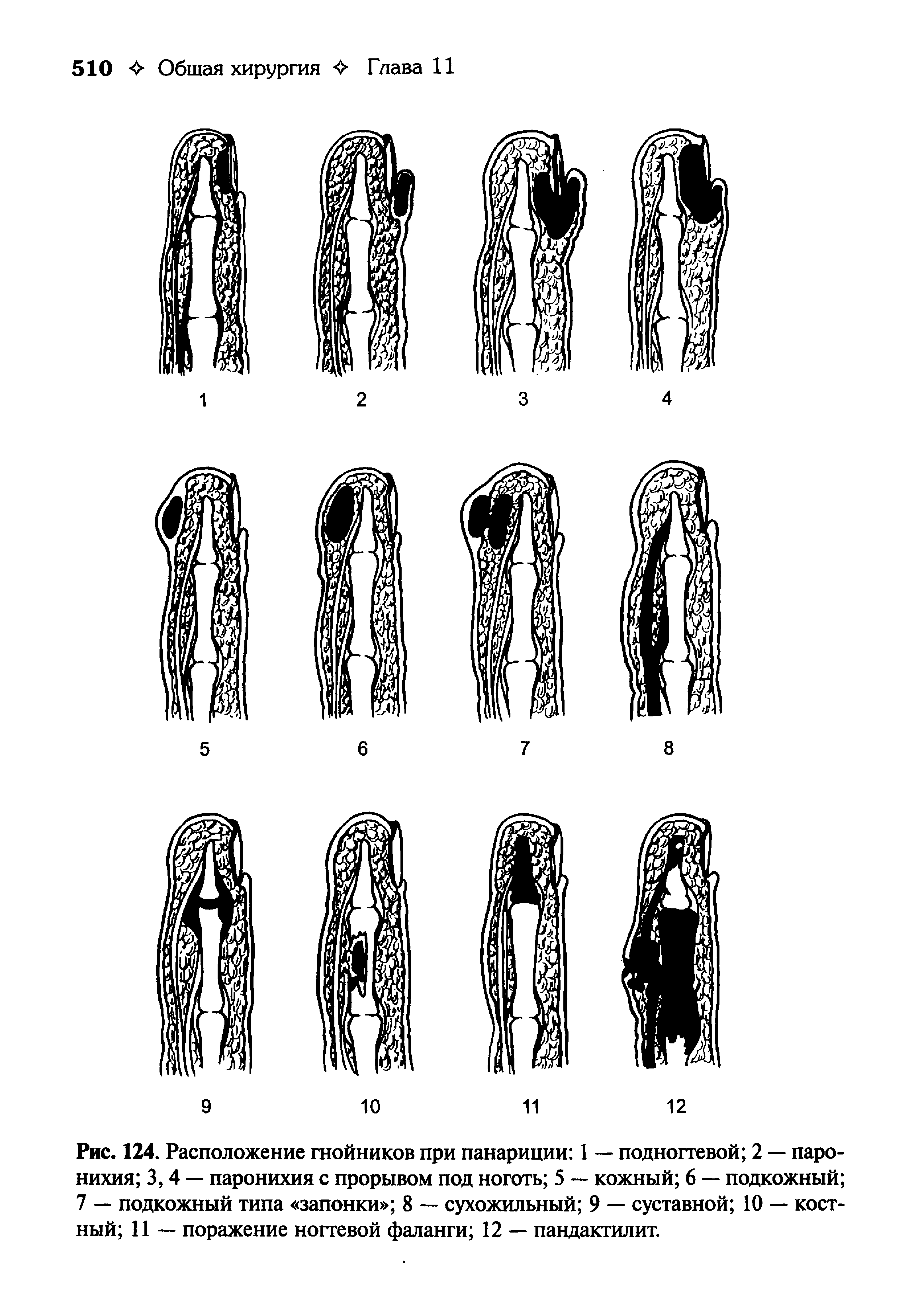 Рис. 124. Расположение гнойников при панариции 1 — подногтевой 2 — паро-нихия 3,4 — паронихия с прорывом под ноготь 5 — кожный 6 — подкожный 7 — подкожный типа запонки 8 — сухожильный 9 — суставной 10 — костный 11 — поражение ногтевой фаланги 12 — пандактилит.