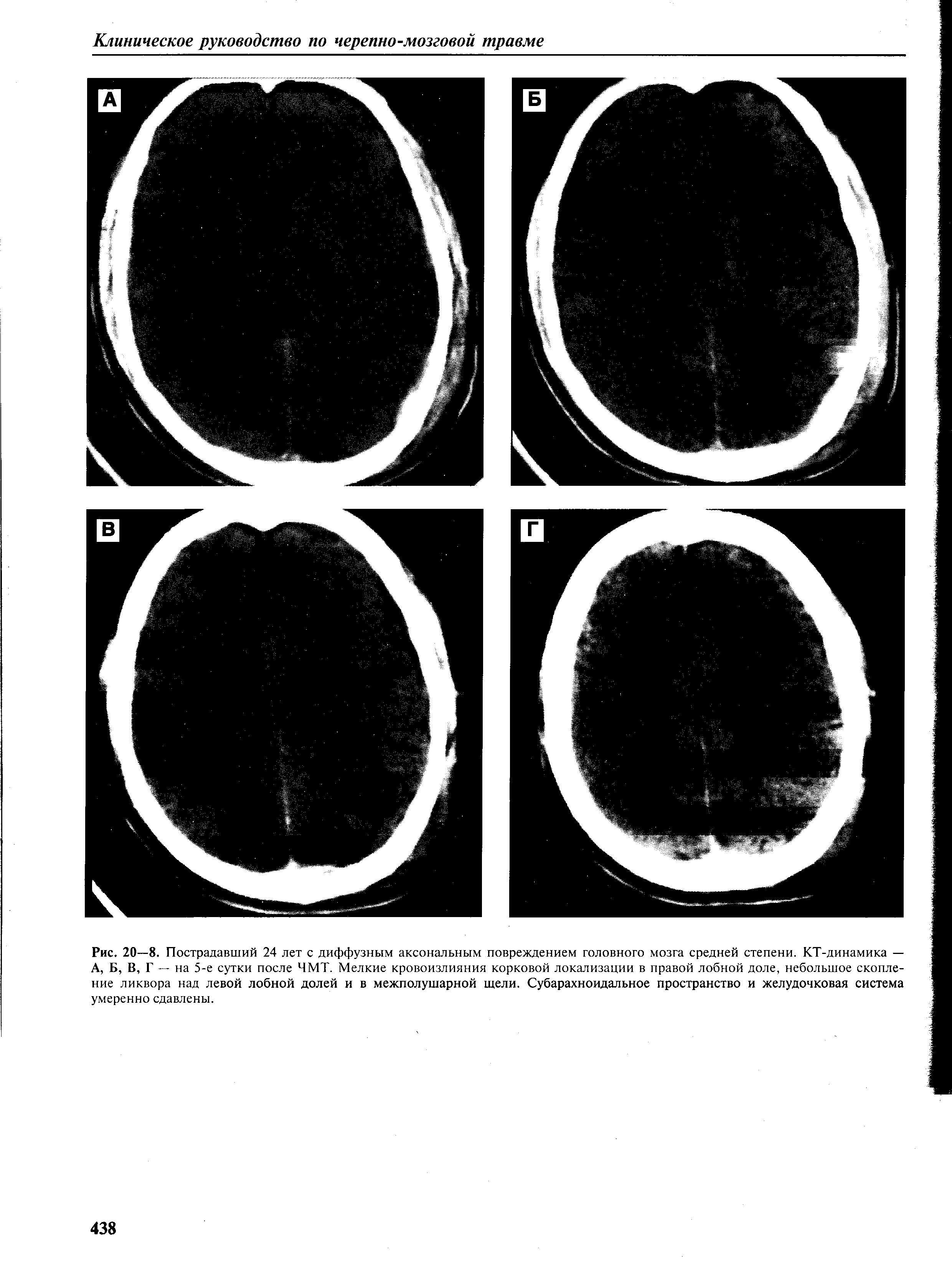 Рис. 20—8. Пострадавший 24 лет с диффузным аксональным повреждением головного мозга средней степени. КТ-динамика — А, Б, В, Г — на 5-е сутки после ЧМТ. Мелкие кровоизлияния корковой локализации в правой лобной доле, небольшое скопление ликвора над левой лобной долей и в межполушарной щели. Субарахноидальное пространство и желудочковая система умеренно сдавлены.