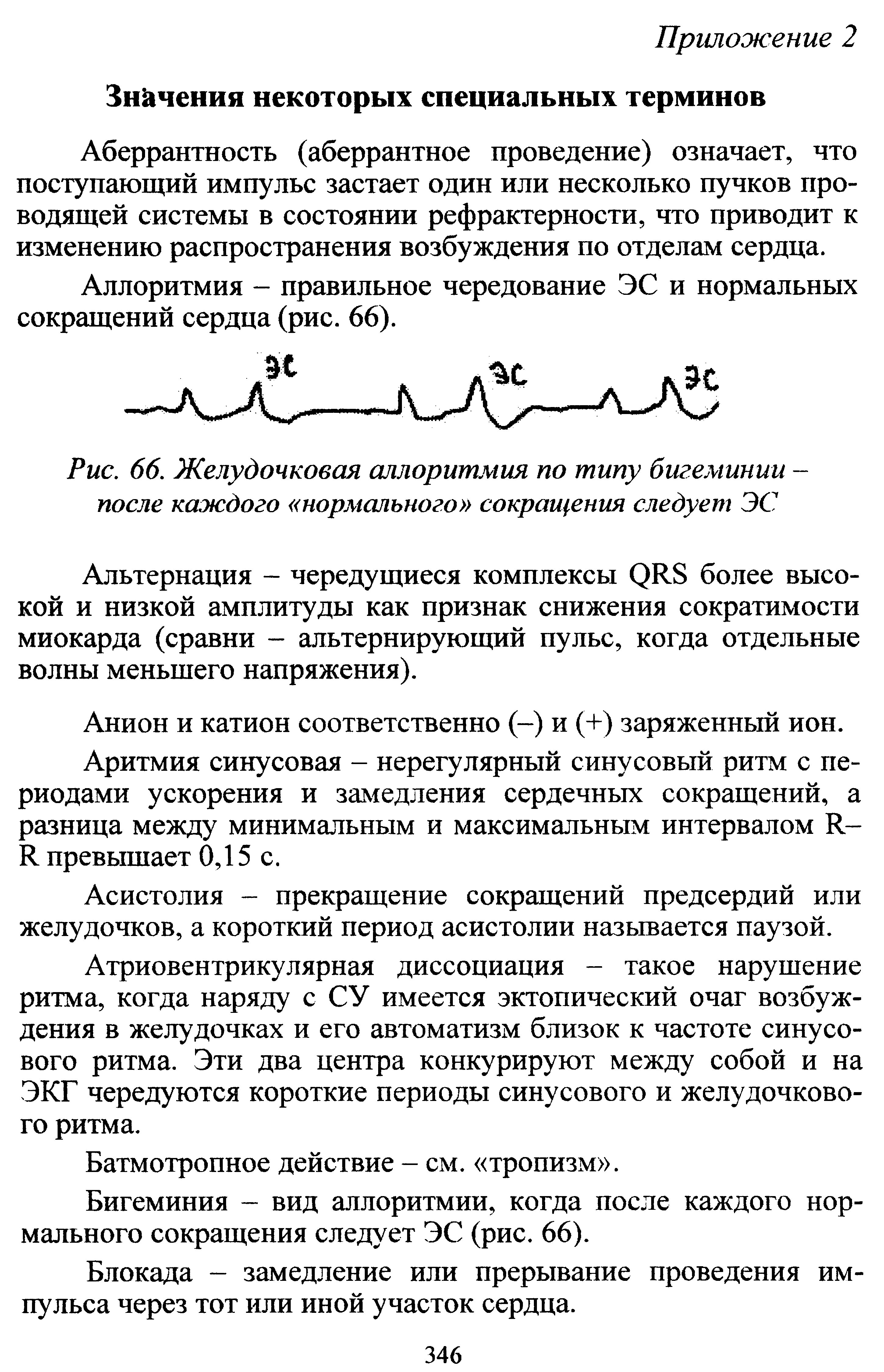 Рис. 66. Желудочковая аллоритмия по типу бигеминии -после каждого нормального сокращения следует ЭС...