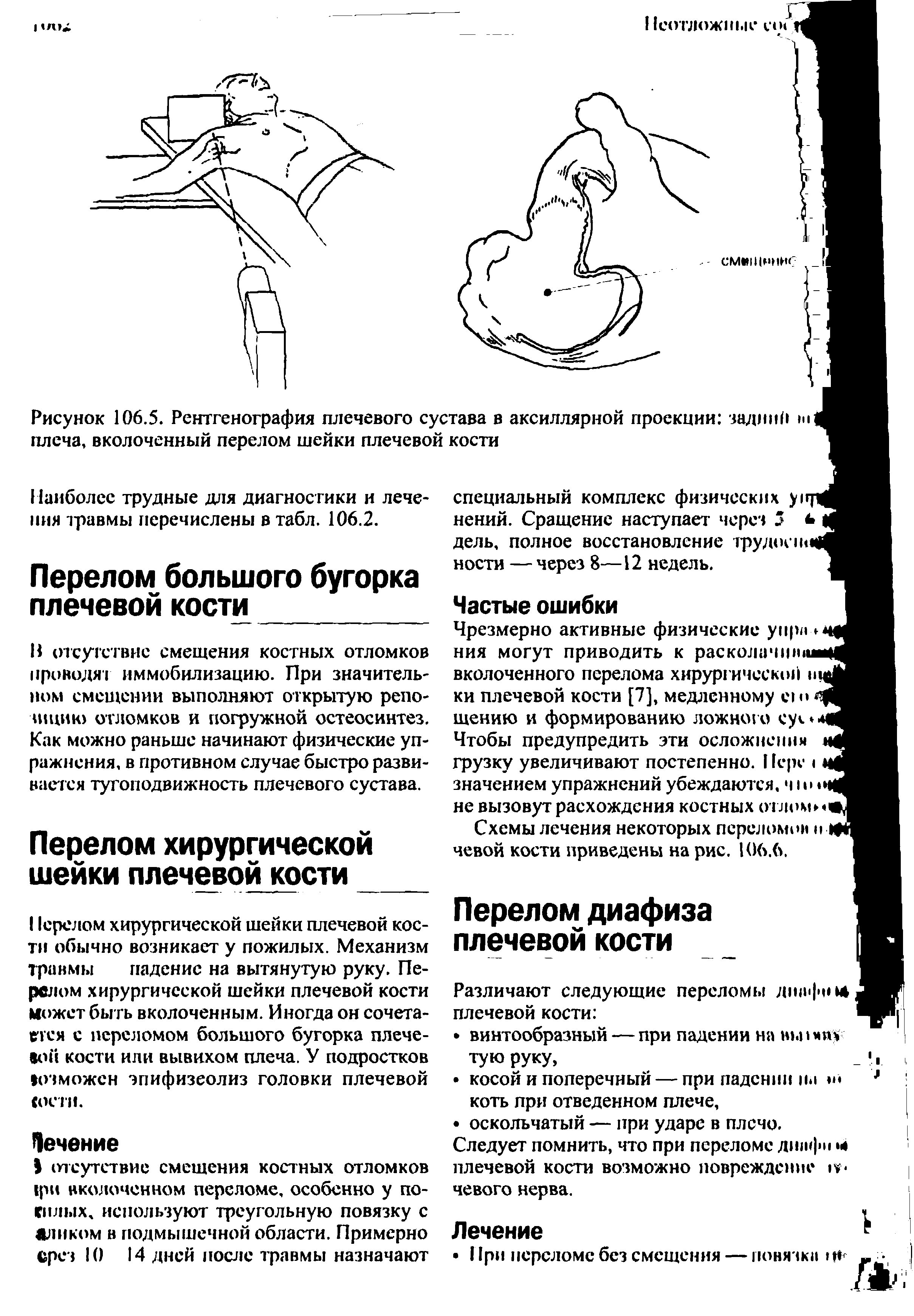 Рисунок 106.5. Рентгенография плечевого сустава в аксиллярной проекции задний ш 1 плеча, вколоченный перелом шейки плечевой кости...