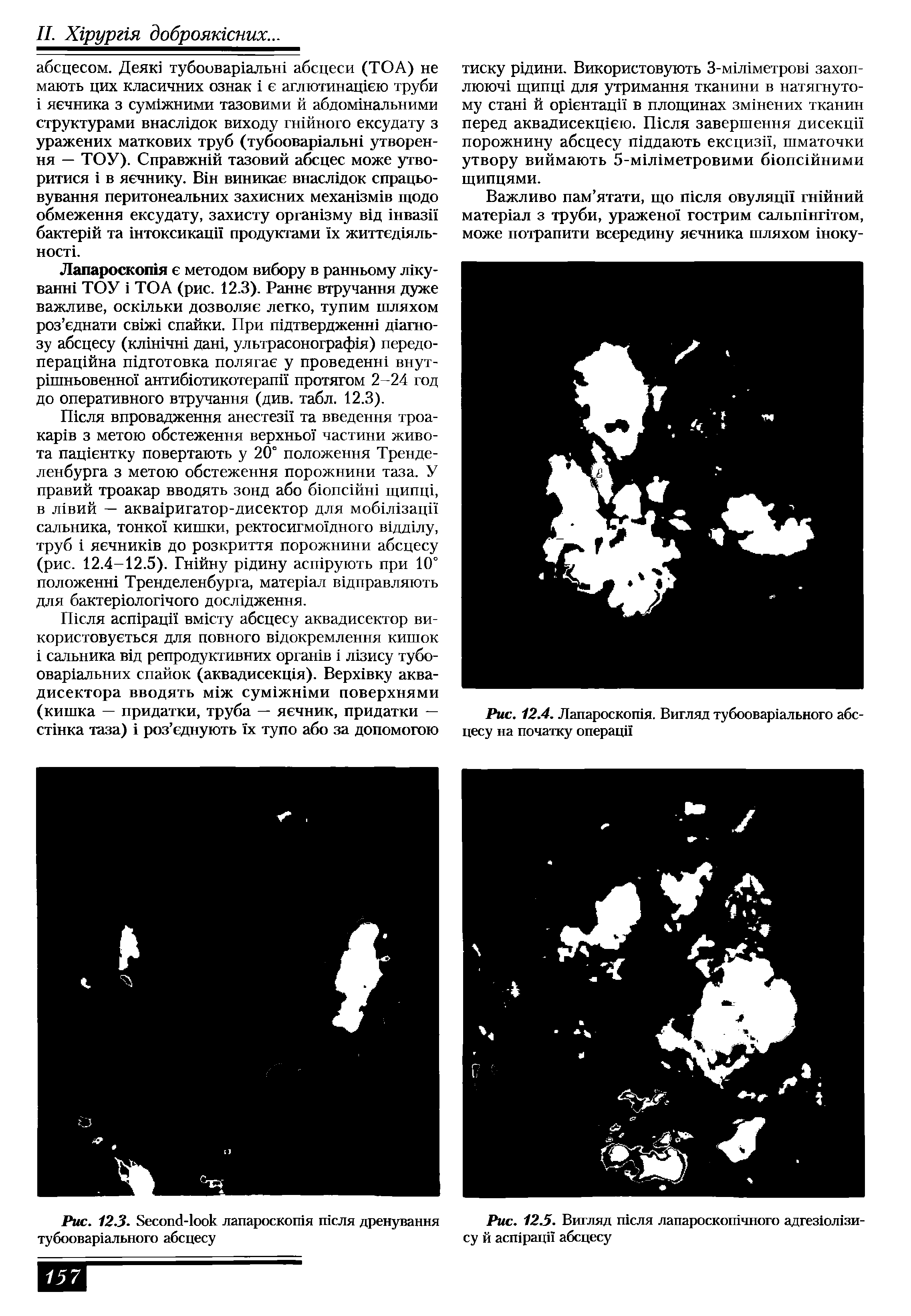 Рис. 12.3. S - лапароскогая шсля дренування Рис. 12.5. Вигляд теля лапароскошчного адгезкмпзи-тубоовар1ального абсцесу су й абсцесу...