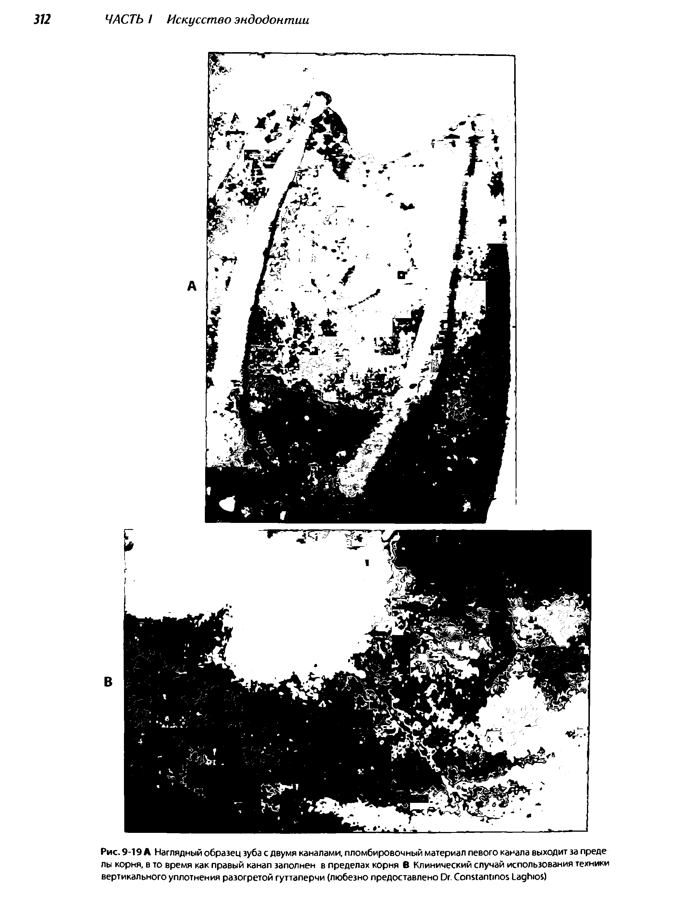 Рис. 9-19 А Наглядный образец зуба с двумя каналами, пломбировочный материал левого канала выходит за преде лы корня, в то время как правый канал заполнен в пределах корня В Клинический случай использования техники вертикального уплотнения разогретой гуттаперчи (любезно предоставлено D . C L )...