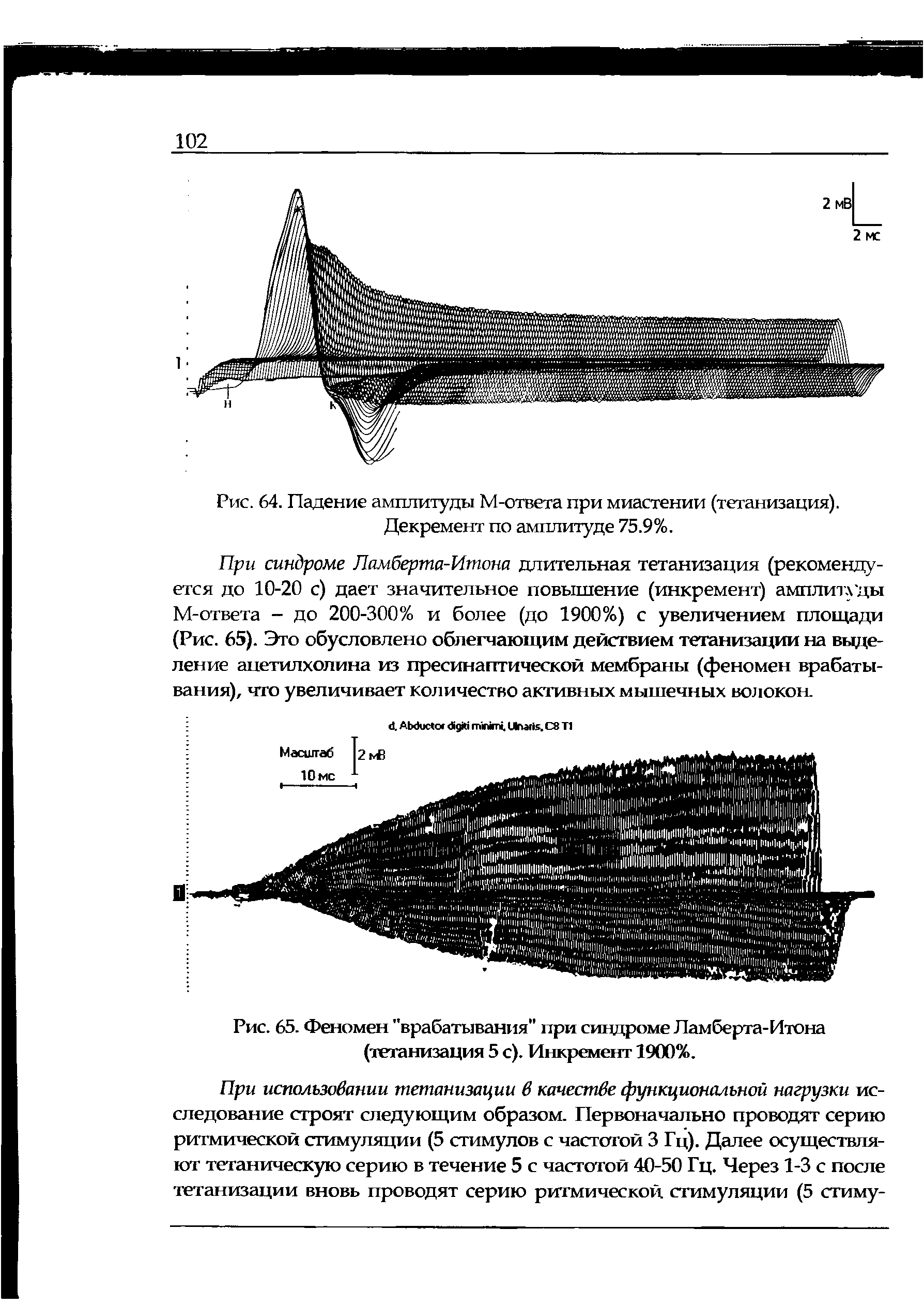 Рис. 65. Феномен "врабатывания при синдроме Ламберта-Итона (тетанизация 5 с). Инкремент 1900%.