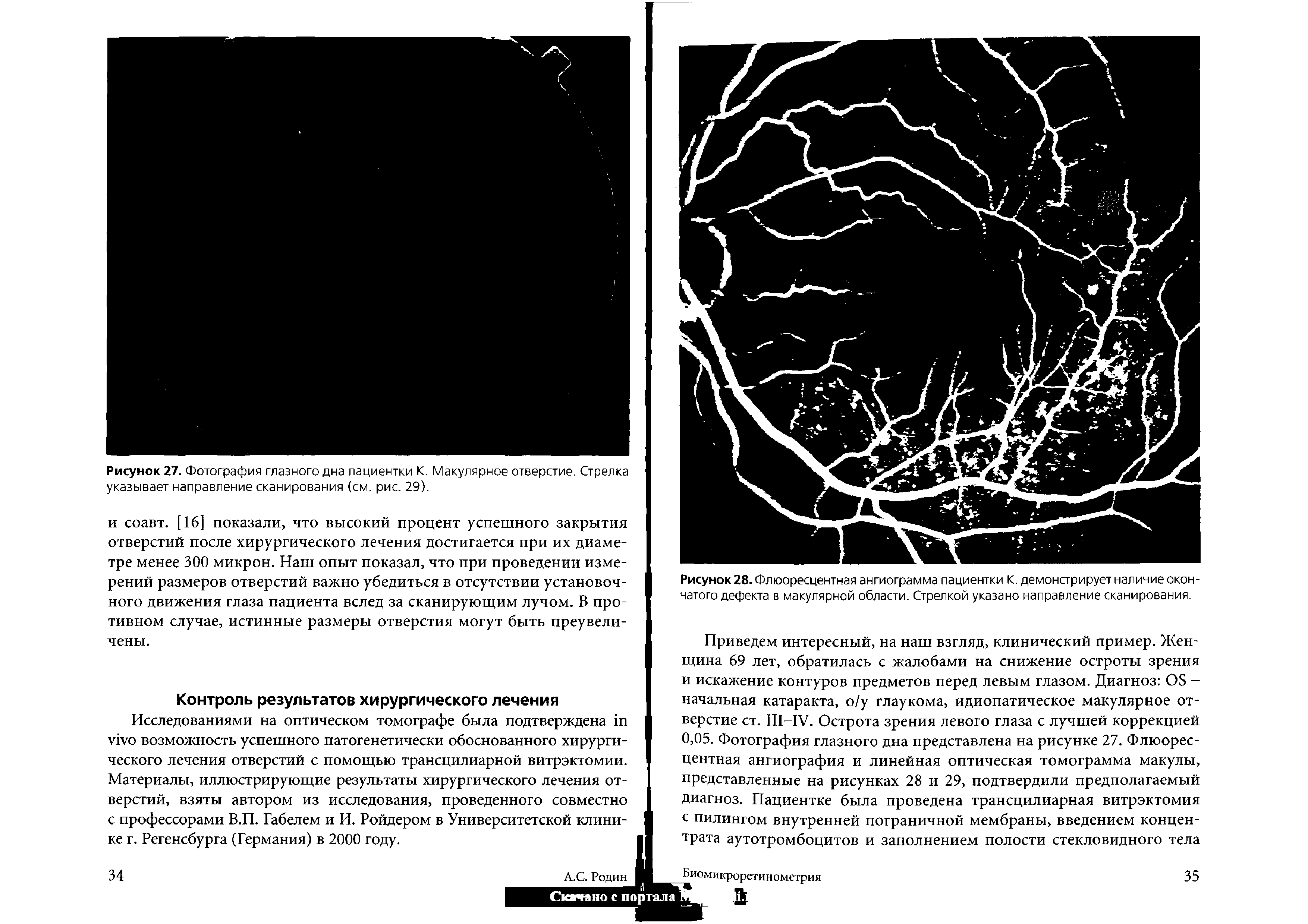 Рисунок 27. Фотография глазногодна пациентки К. Макулярное отверстие. Стрелка указывает направление сканирования (см. рис. 29).