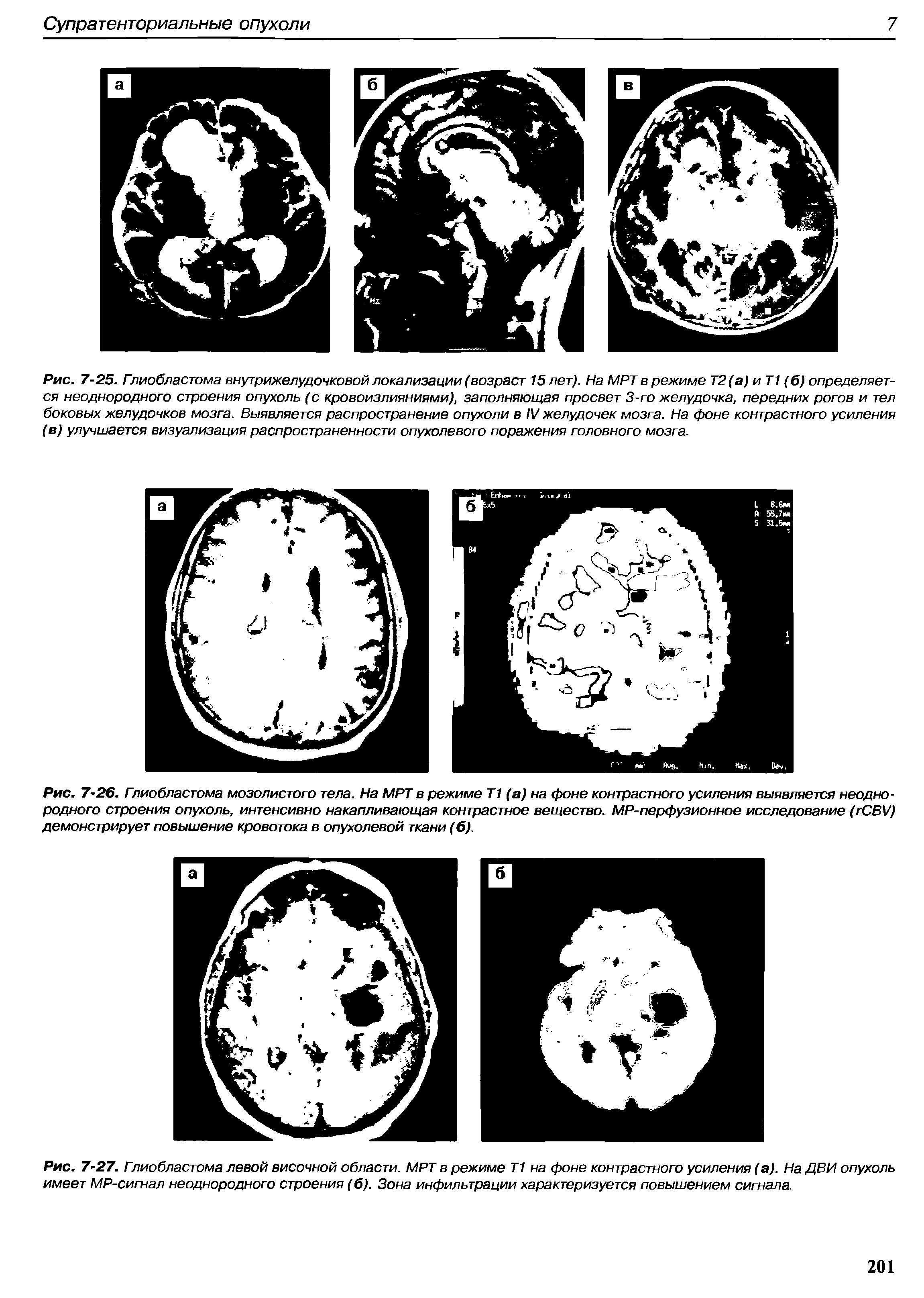 Рис. 7-26. Глиобластома мозолистого тела. На МРТ в режиме Т1 (а) на фоне контрастного усиления выявляется неоднородного строения опухоль, интенсивно накапливающая контрастное вещество. MP-перфузионное исследование ( CBV) демонстрирует повышение кровотока в опухолевой ткани (б).