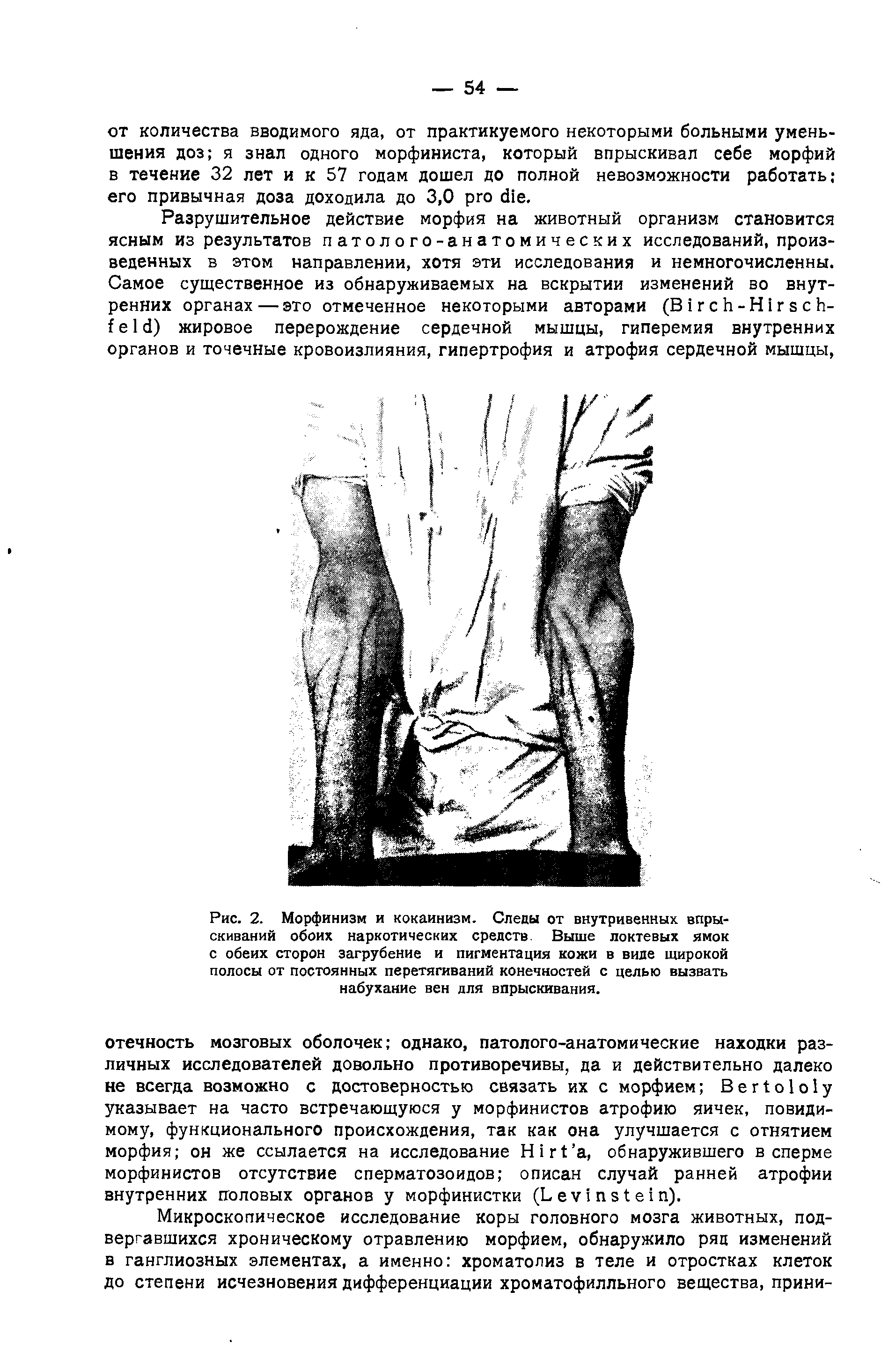 Рис. 2. Морфинизм и кокаинизм. Следы от внутривенных впрыскиваний обоих наркотических средств. Выше локтевых ямок с обеих сторон загрубение и пигментация кожи в виде широкой полосы от постоянных перетягиваний конечностей с целью вызвать набухание вен для впрыскивания.